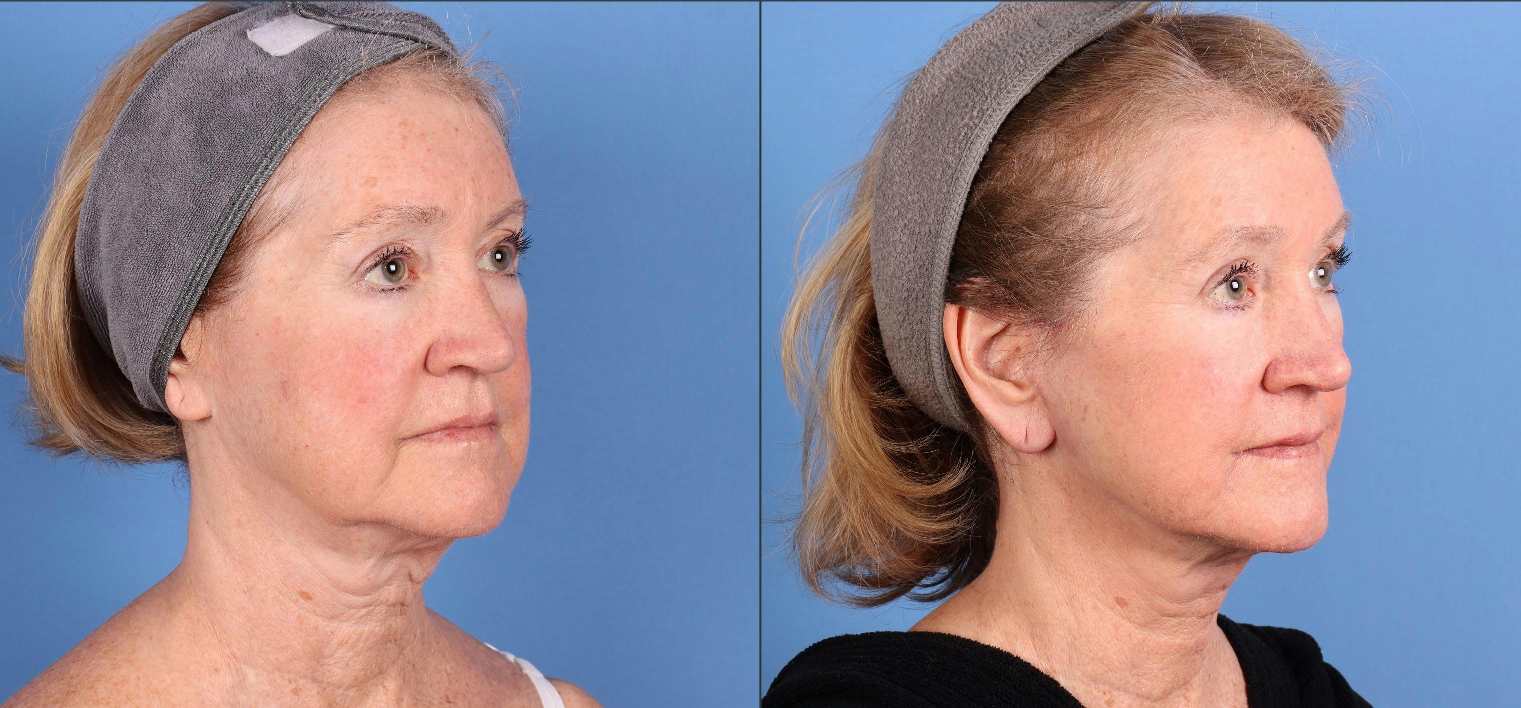 Mini Facelift Before & After Gallery - Patient 362980 - Image 2