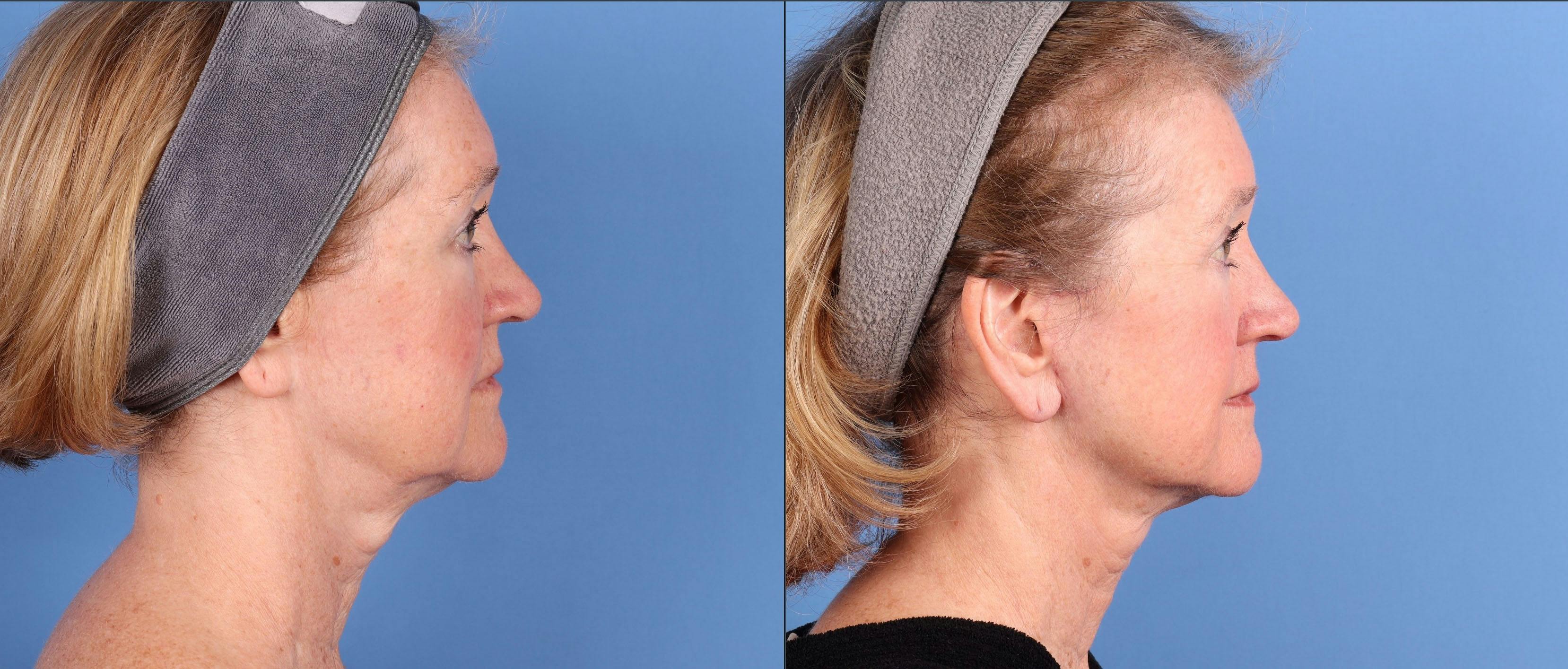 Mini Facelift Before & After Gallery - Patient 362980 - Image 3