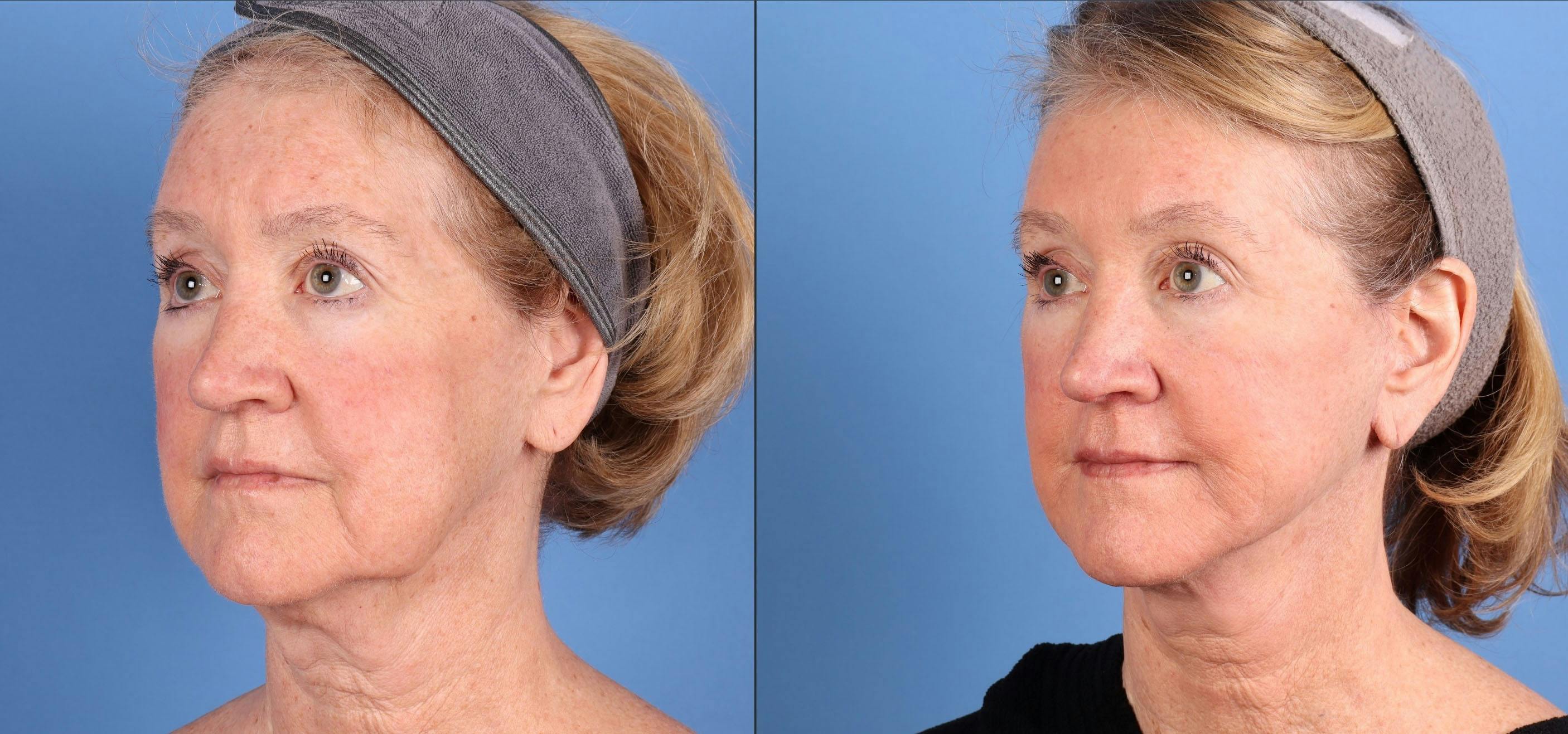 Mini Facelift Before & After Gallery - Patient 362980 - Image 4