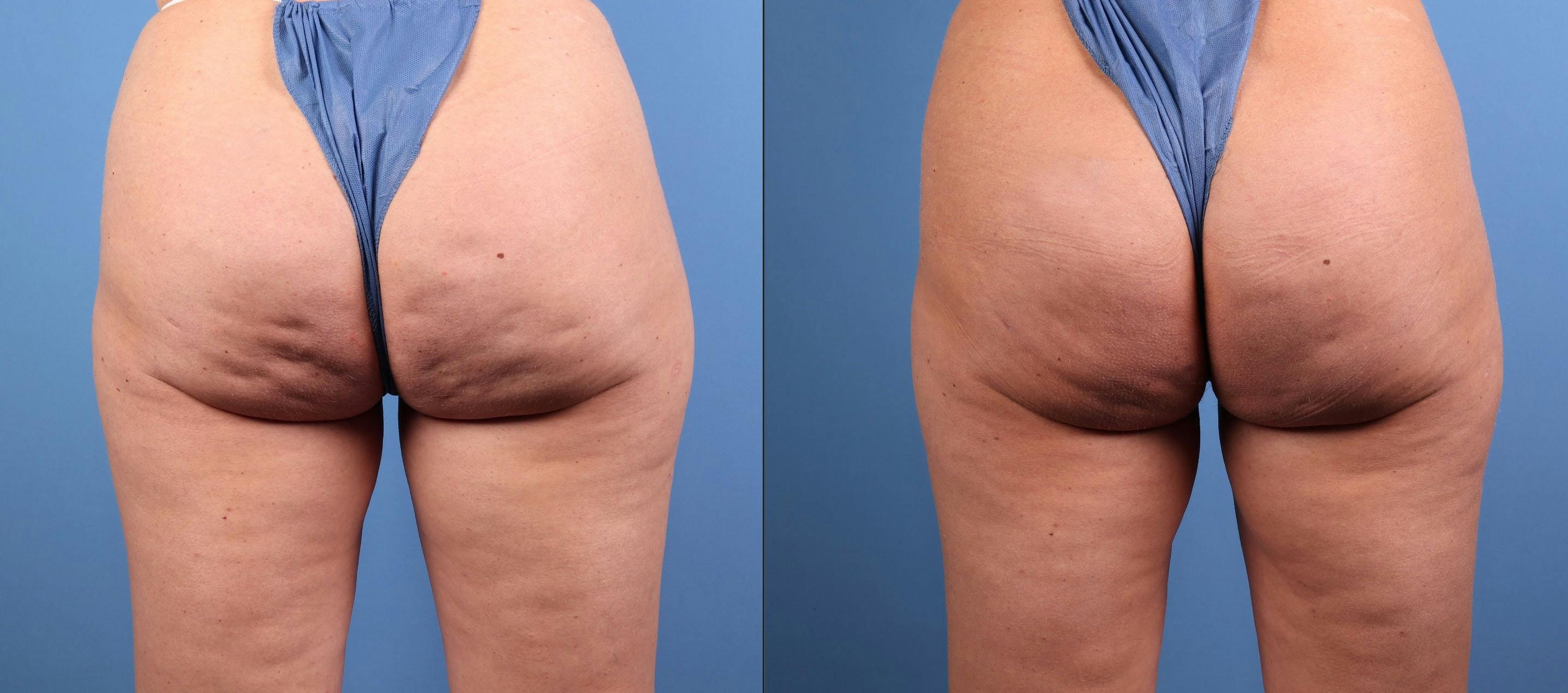 Aveli Before & After Gallery - Patient 235398 - Image 1