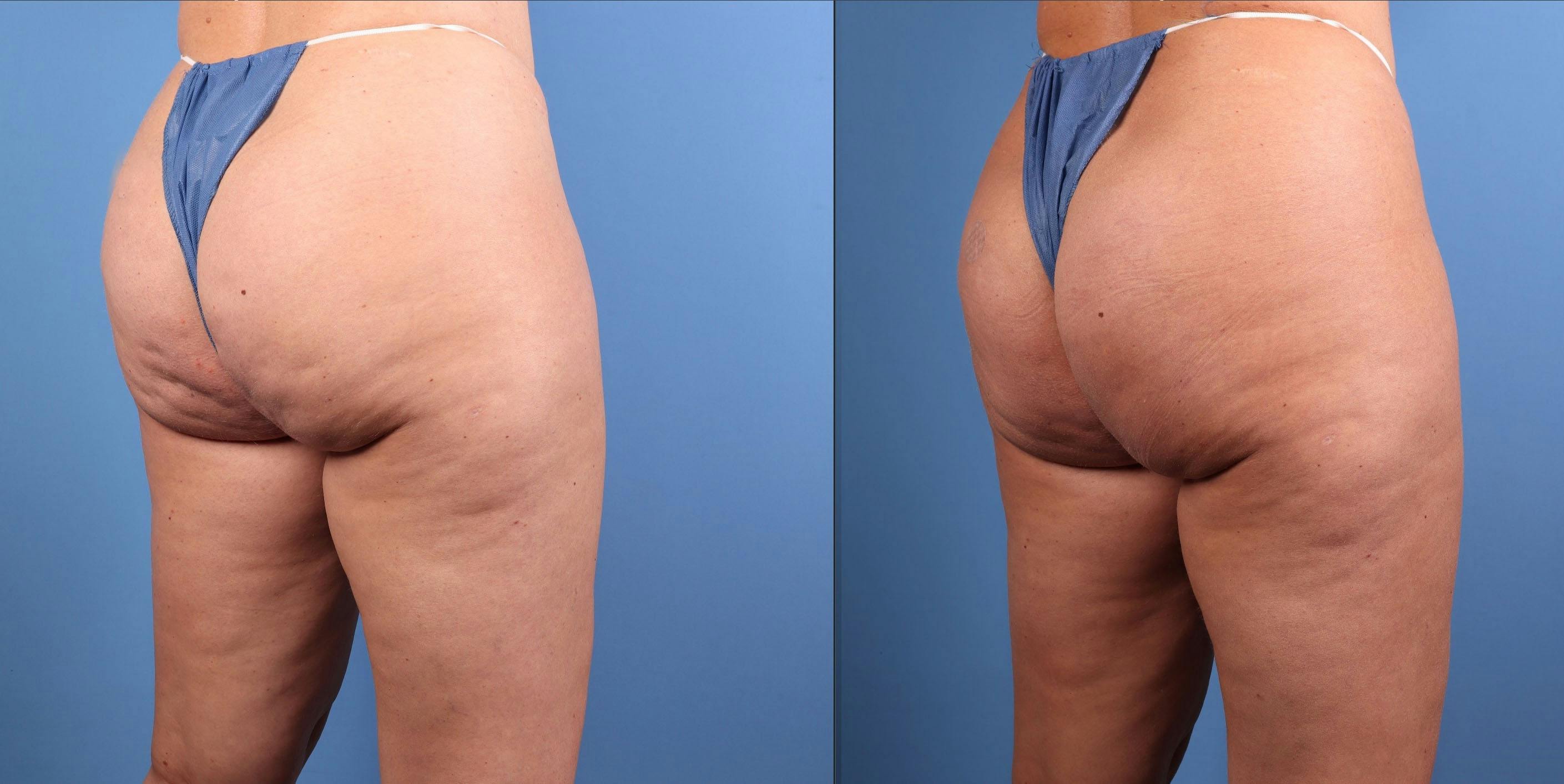 Aveli Before & After Gallery - Patient 235398 - Image 2