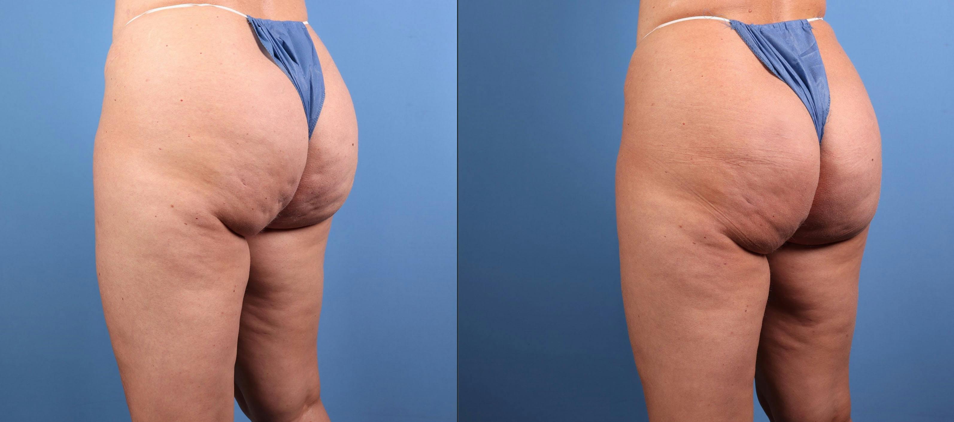 Aveli Before & After Gallery - Patient 235398 - Image 3