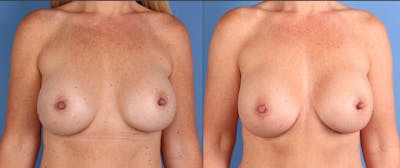 Breast Revision Before & After Gallery - Patient 128331 - Image 1