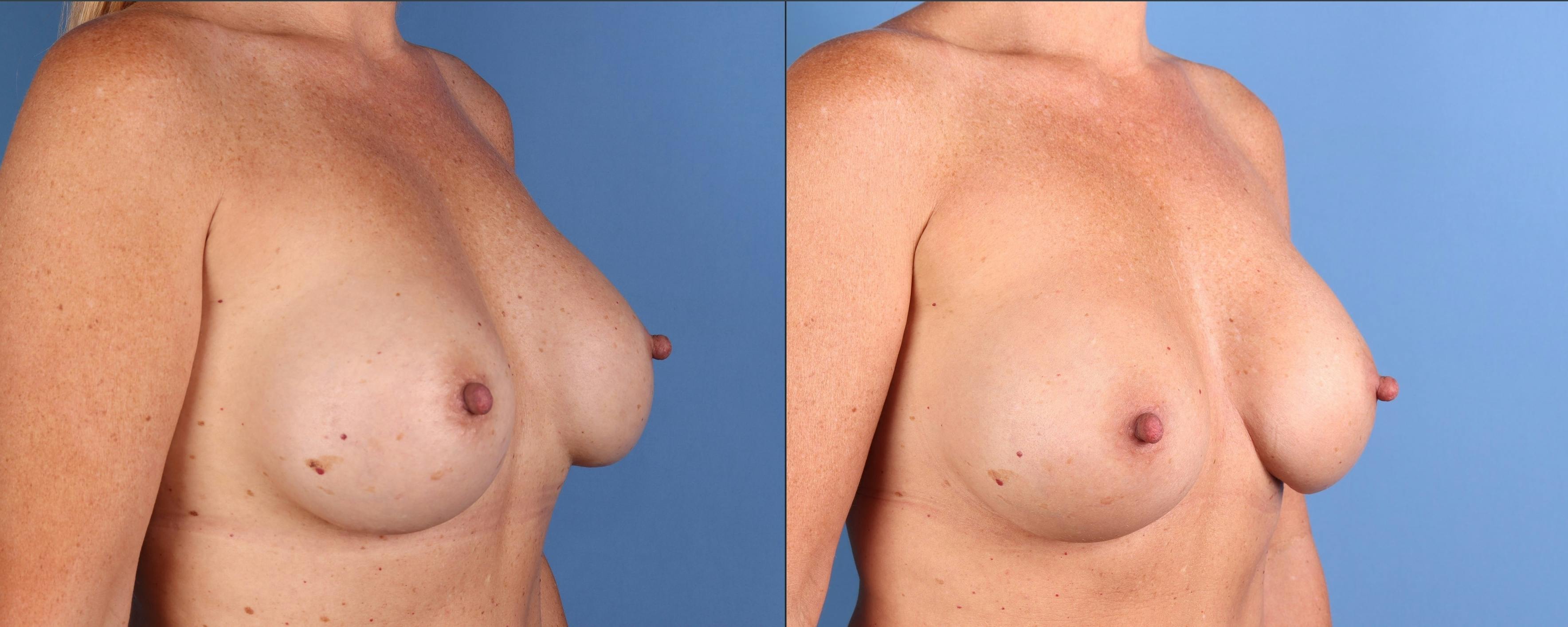 Breast Revision Before & After Gallery - Patient 128331 - Image 2