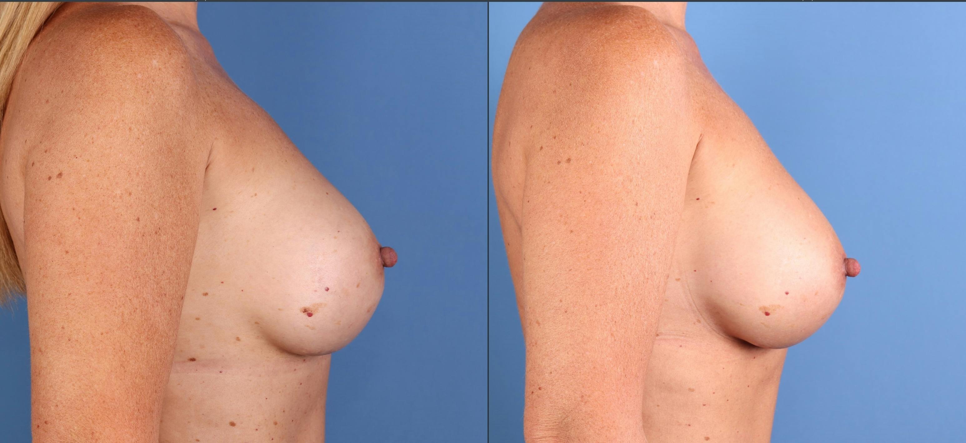 Breast Revision Before & After Gallery - Patient 128331 - Image 3