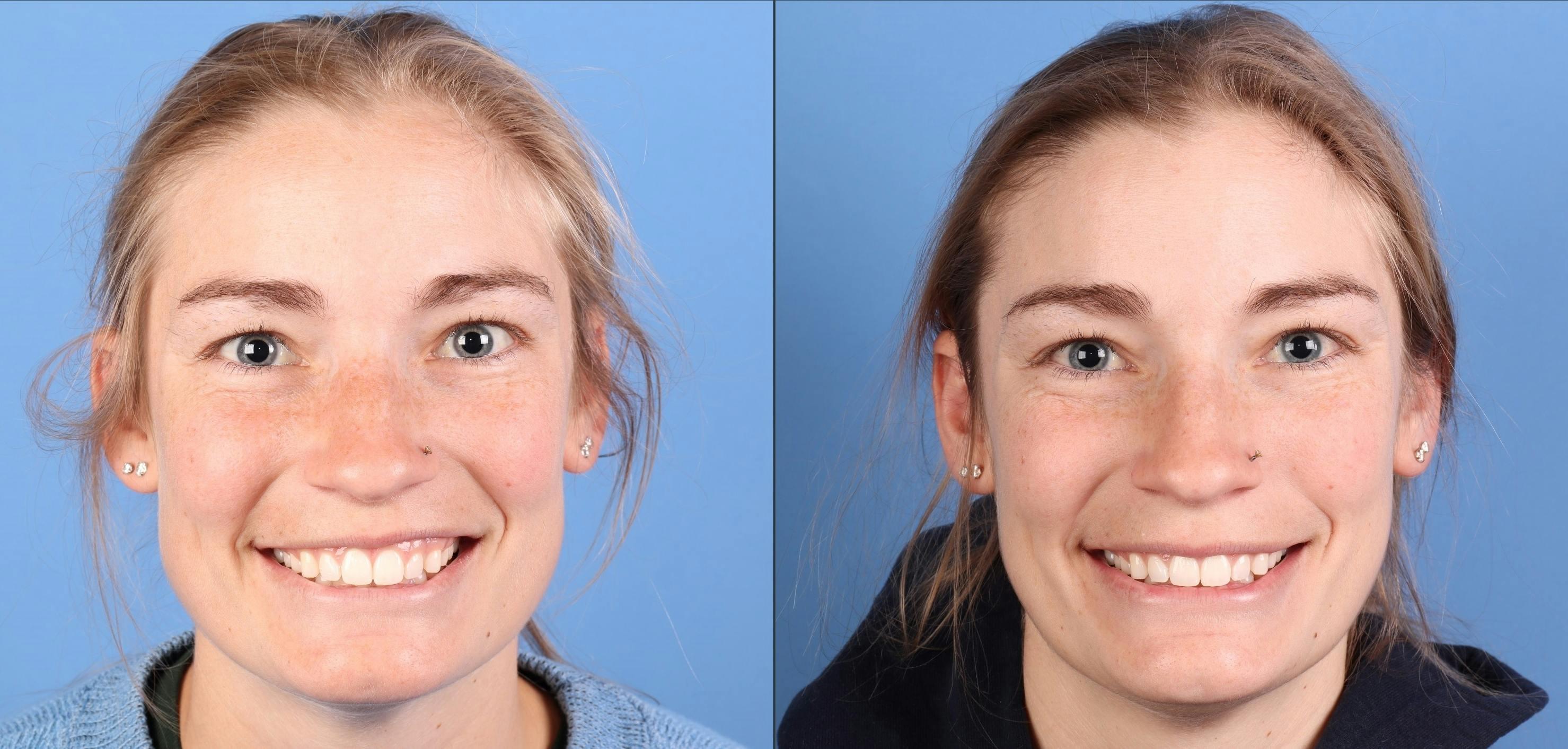 Botox