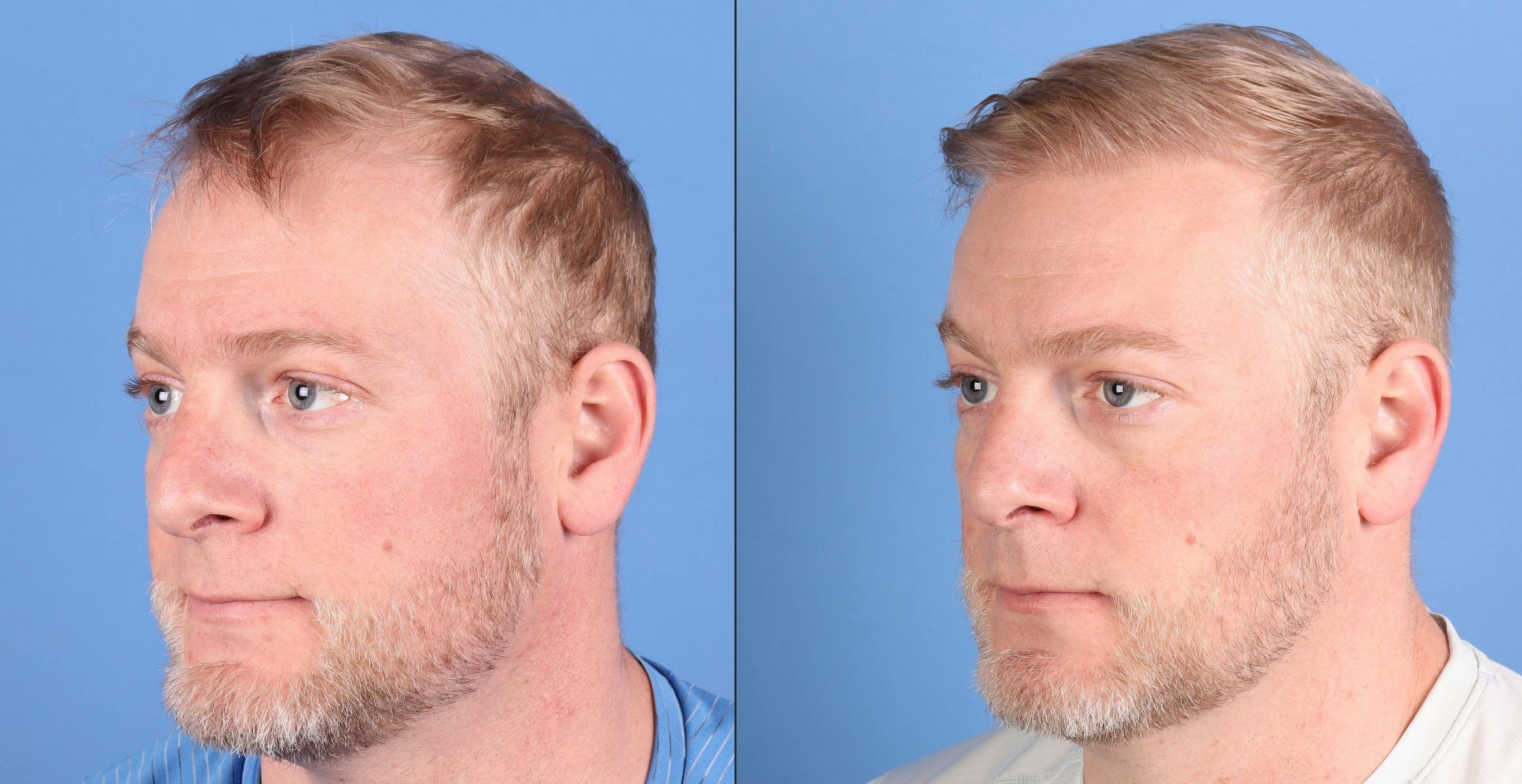 NeoGraft Hair Restoration Before & After Gallery - Patient 131161 - Image 4