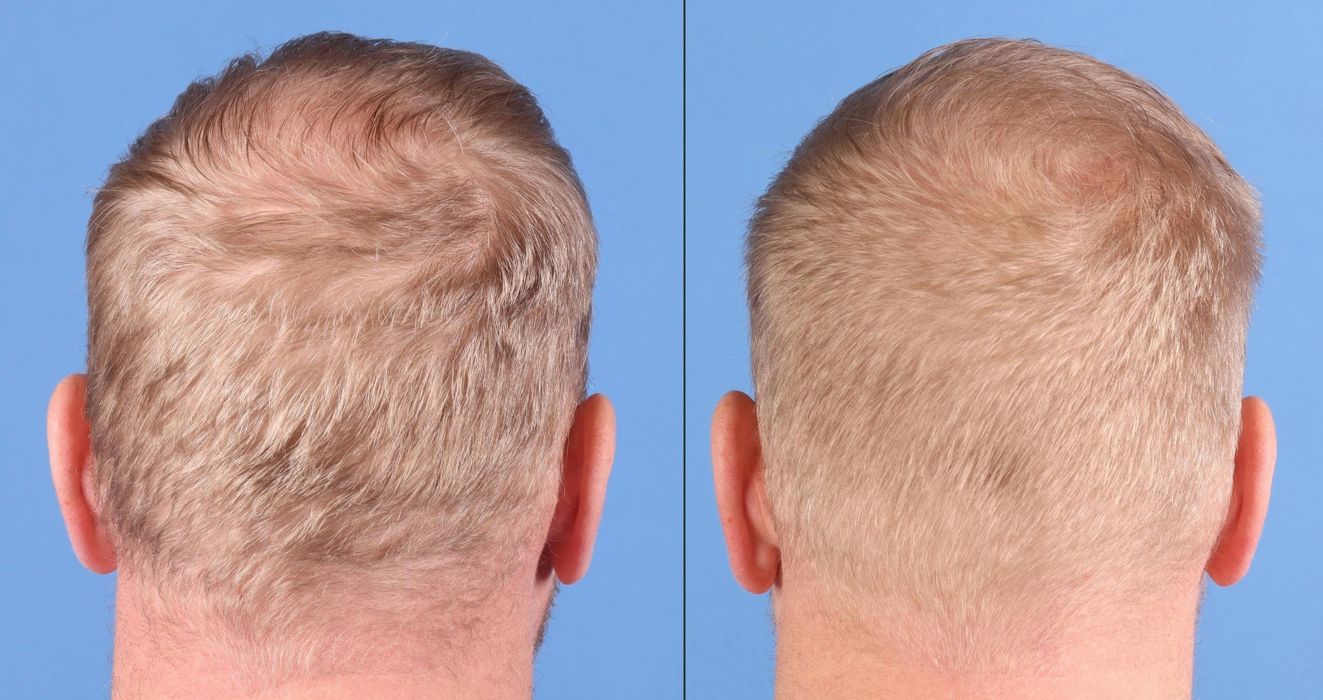 NeoGraft Hair Restoration Before & After Gallery - Patient 131161 - Image 7