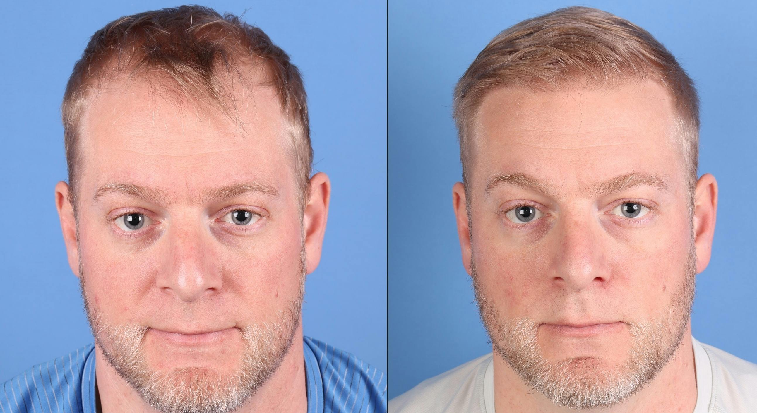 NeoGraft Hair Restoration Before & After Gallery - Patient 131161 - Image 1