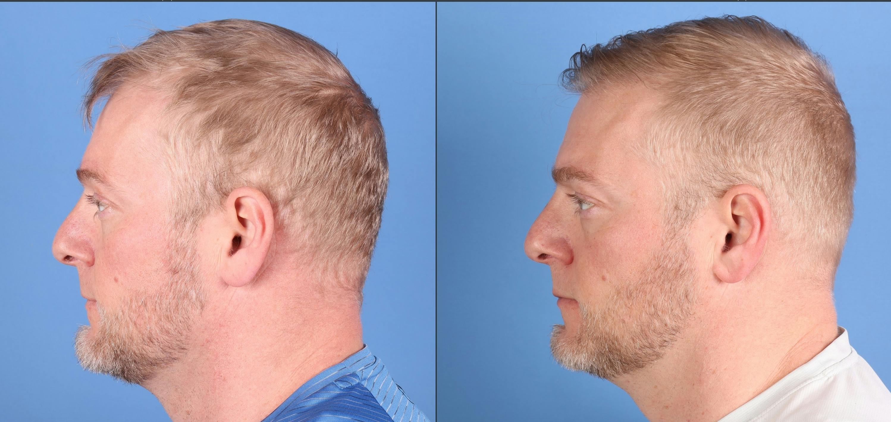 NeoGraft Hair Restoration Before & After Gallery - Patient 131161 - Image 5
