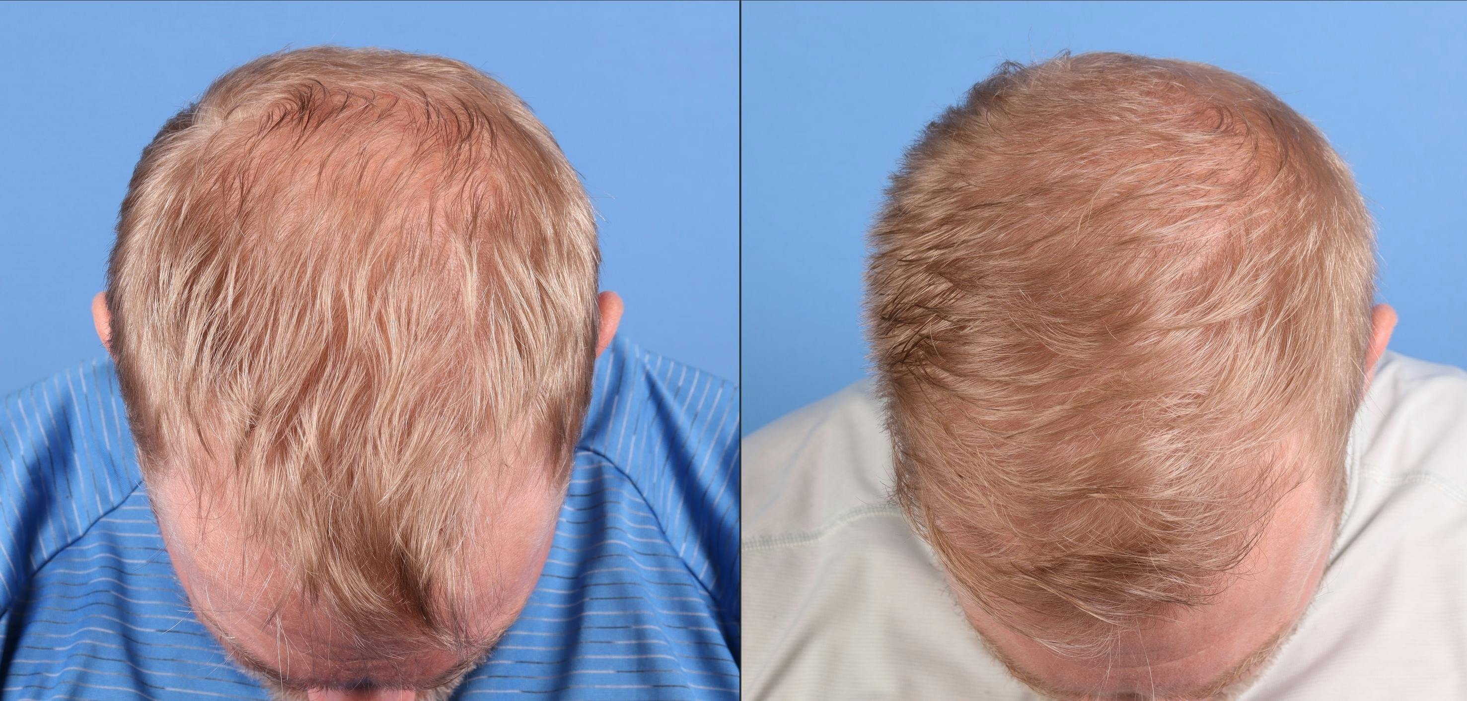 NeoGraft Hair Restoration Before & After Gallery - Patient 131161 - Image 8