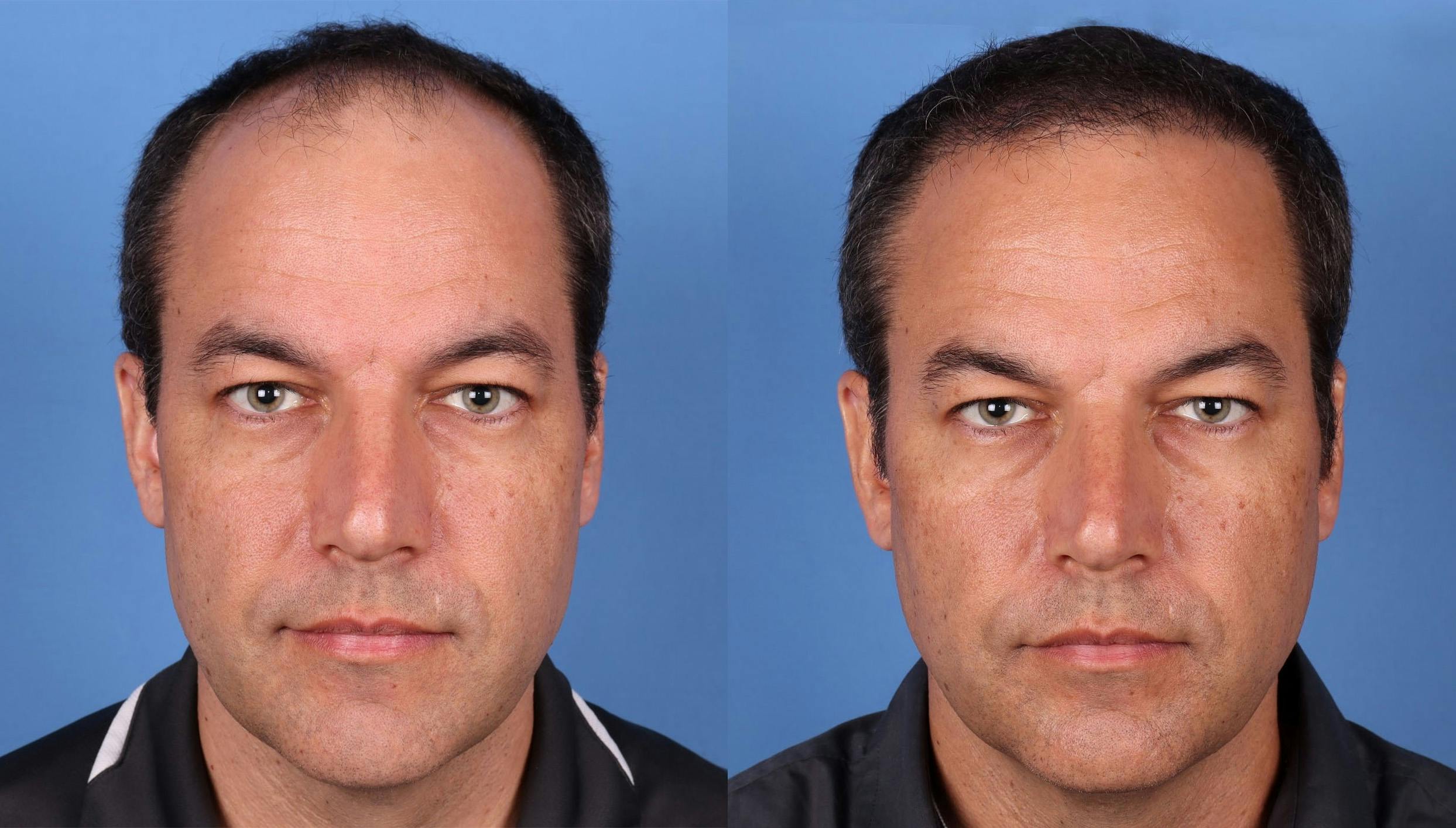 NeoGraft Hair Restoration Before & After Gallery - Patient 148560766 - Image 1