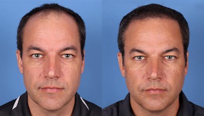 NeoGraft Hair Restoration Before & After Gallery - Patient 148560766 - Image 1