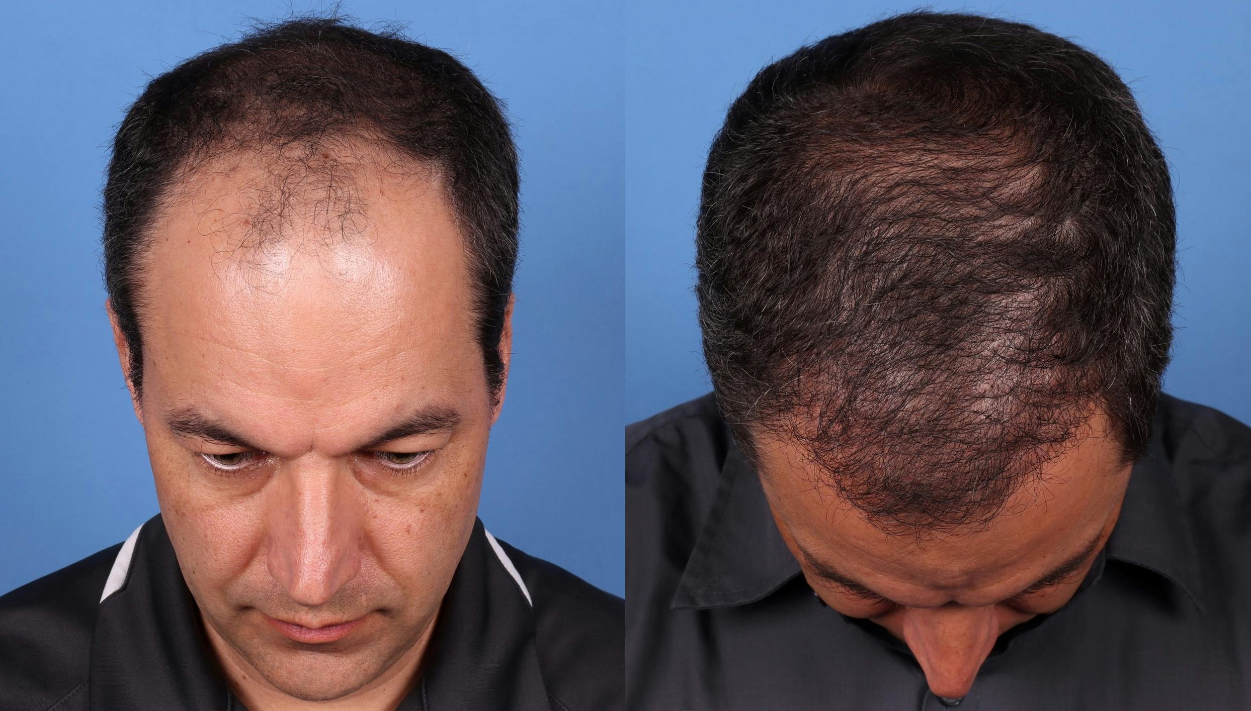 NeoGraft Hair Restoration Before & After Gallery - Patient 148560766 - Image 5