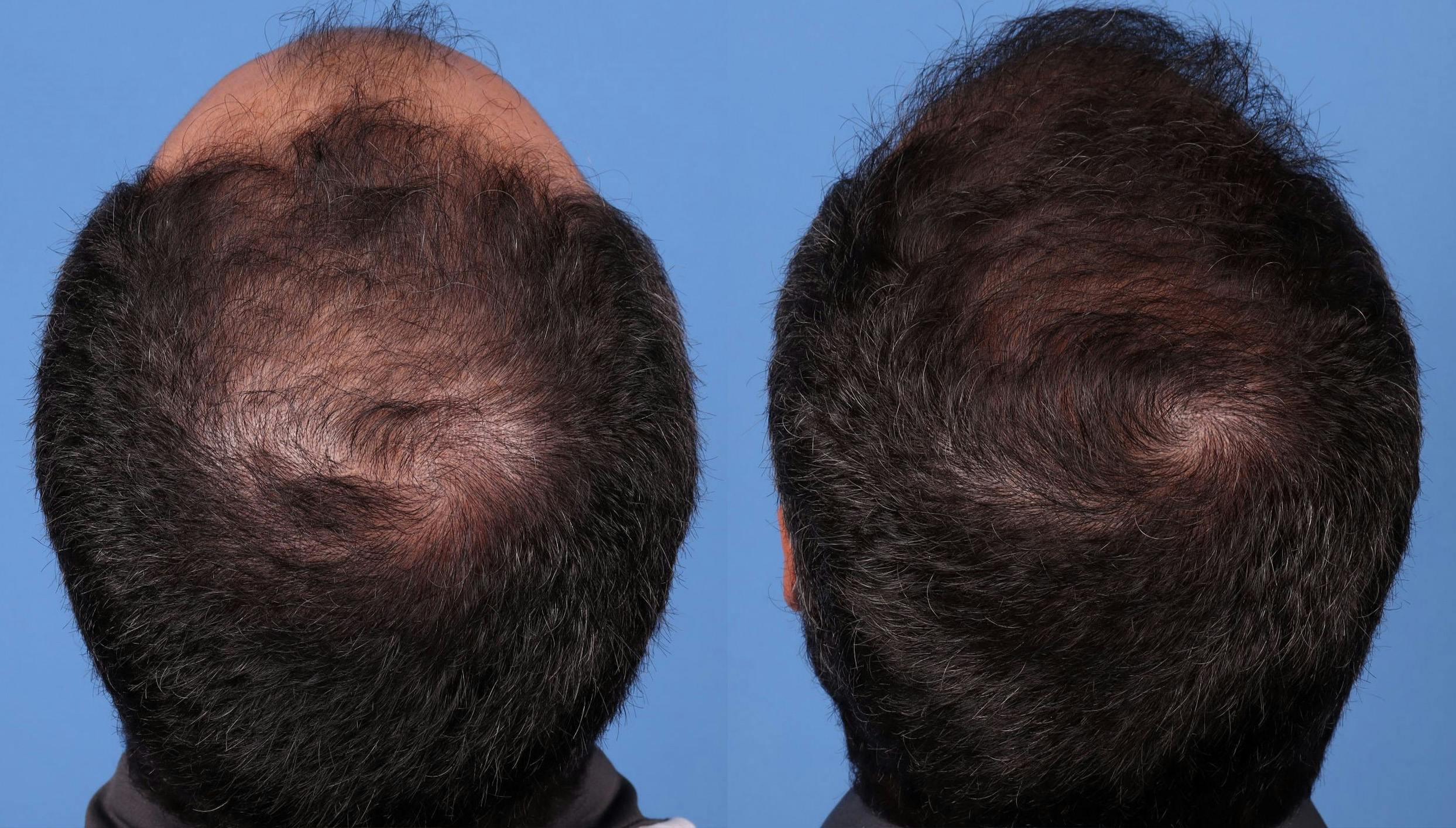 NeoGraft Hair Restoration Before & After Gallery - Patient 148560766 - Image 4