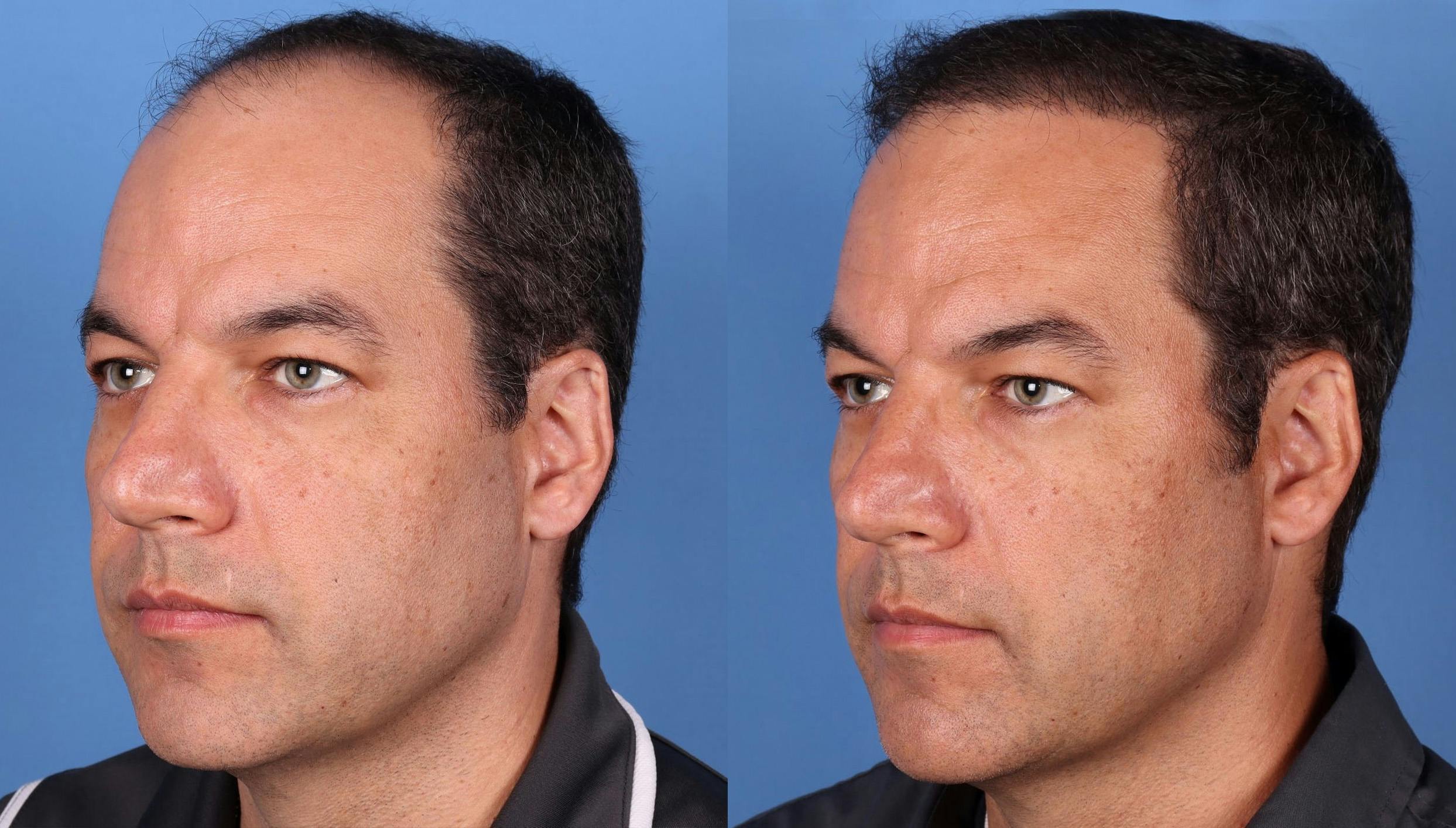 NeoGraft Hair Restoration Before & After Gallery - Patient 148560766 - Image 2