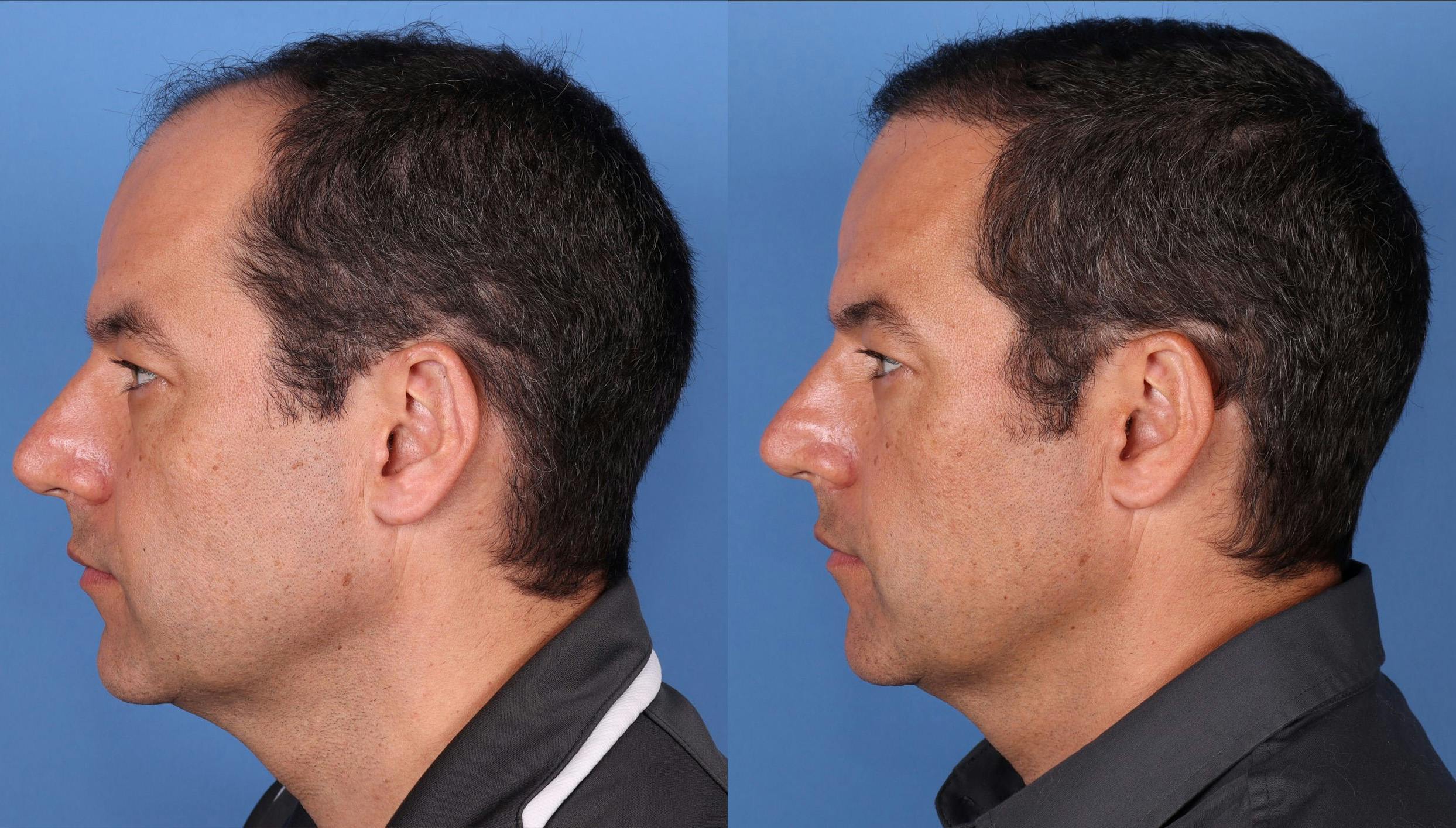 NeoGraft Hair Restoration Before & After Gallery - Patient 148560766 - Image 3