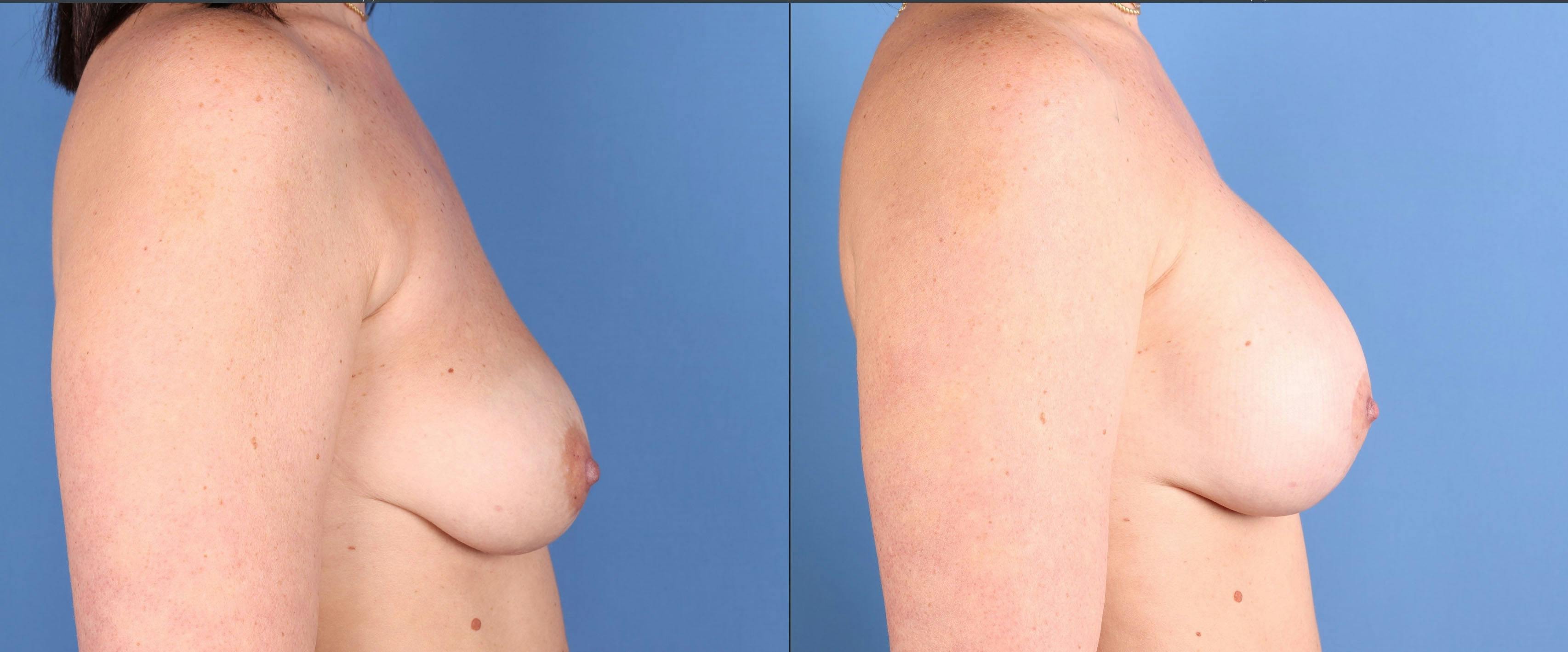 Breast Augmentation Before & After Gallery - Patient 121993 - Image 3