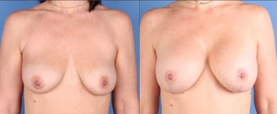 Breast Lift Before & After Gallery - Patient 421629 - Image 1