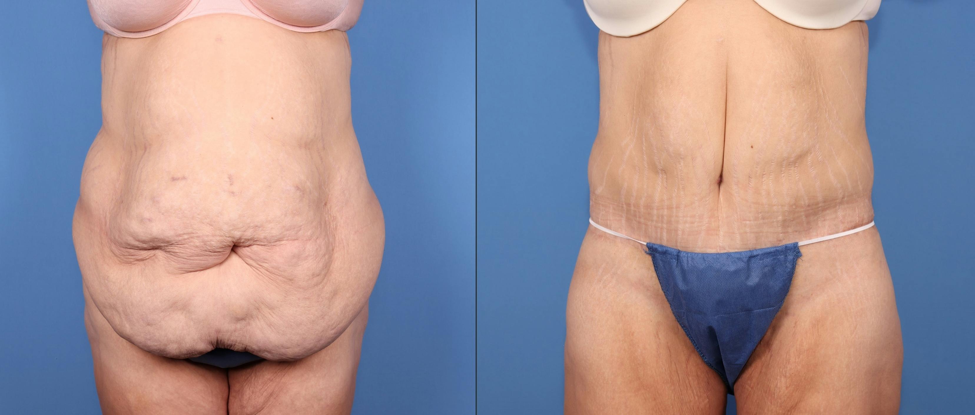 Tummy Tuck Before & After Gallery - Patient 125391 - Image 2