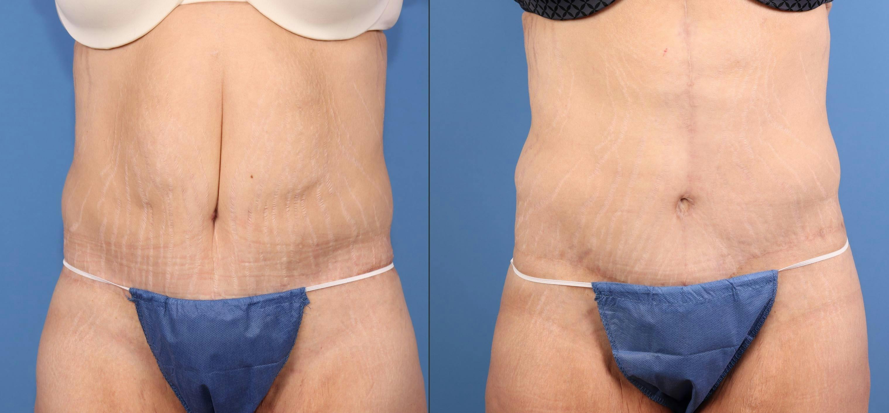 Tummy Tuck Before & After Gallery - Patient 125391 - Image 3