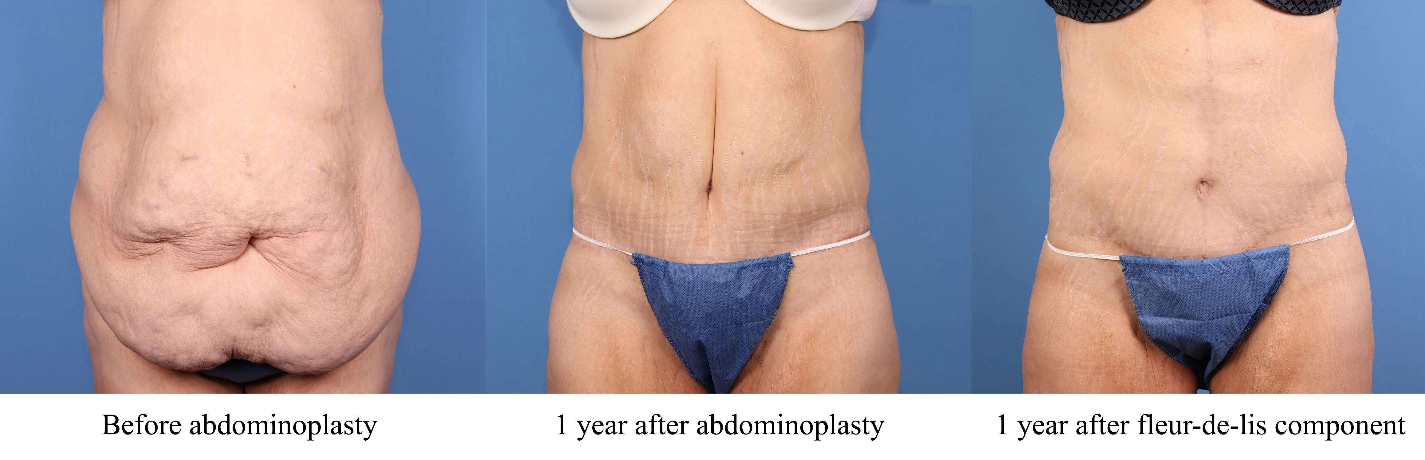 Tummy Tuck Before & After Gallery - Patient 125391 - Image 4