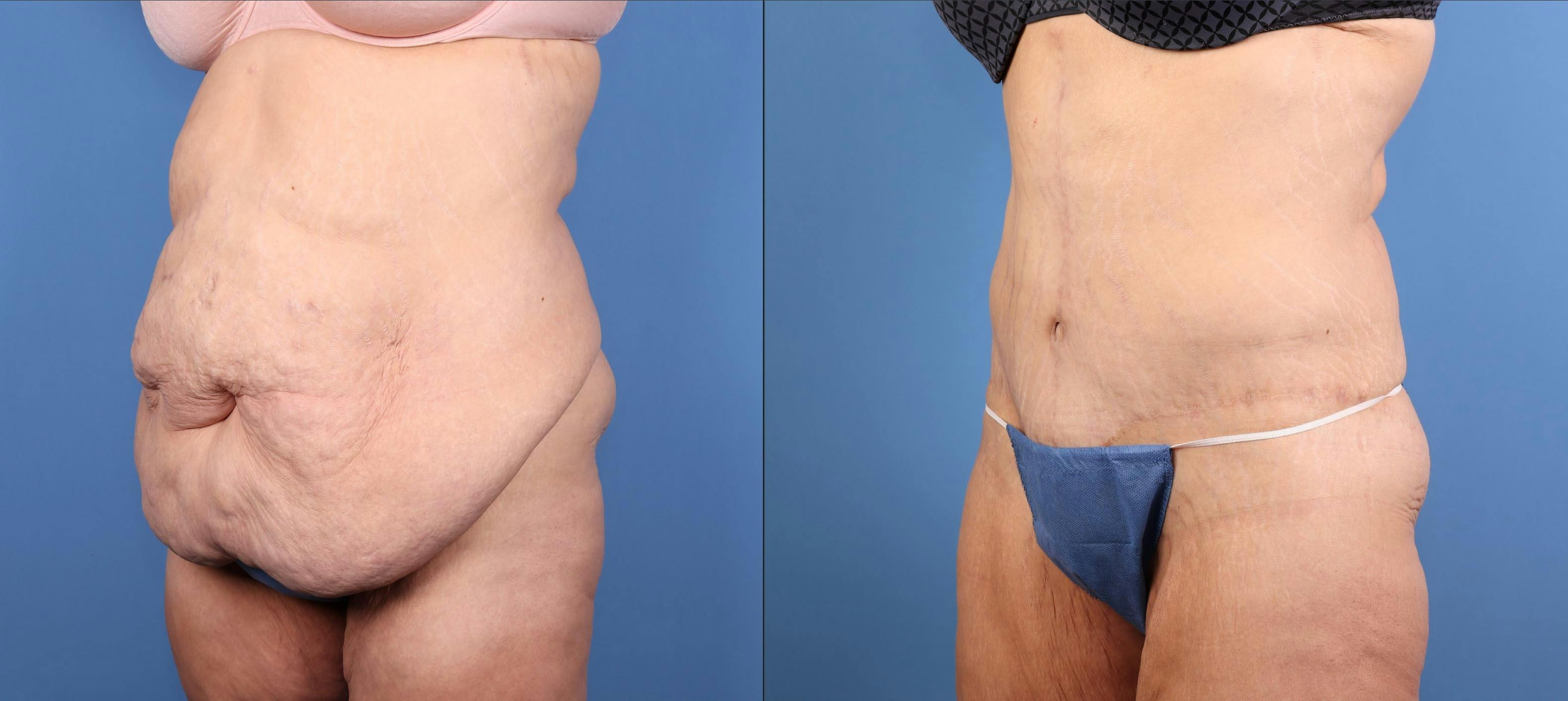 Tummy Tuck Before & After Gallery - Patient 125391 - Image 6