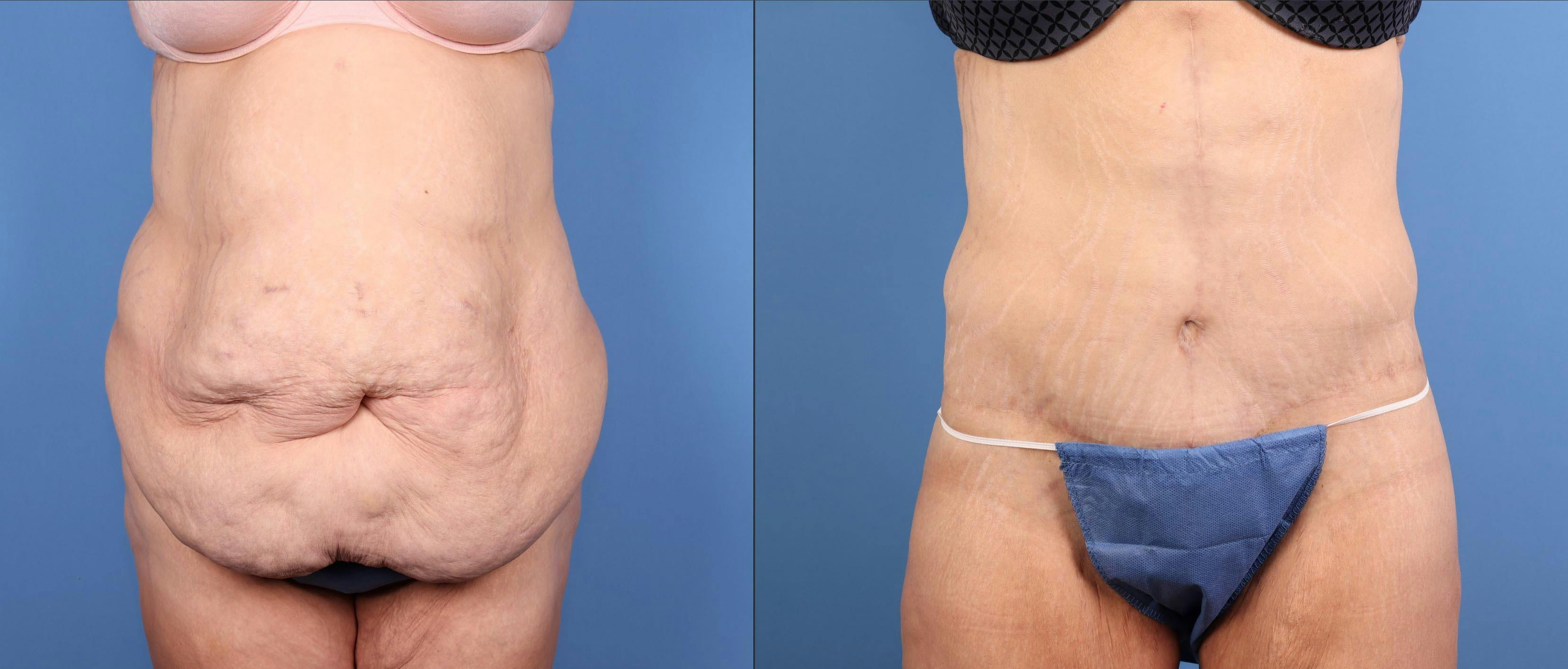 Tummy Tuck Before & After Gallery - Patient 125391 - Image 1