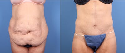 Tummy Tuck Before & After Gallery - Patient 125391 - Image 1