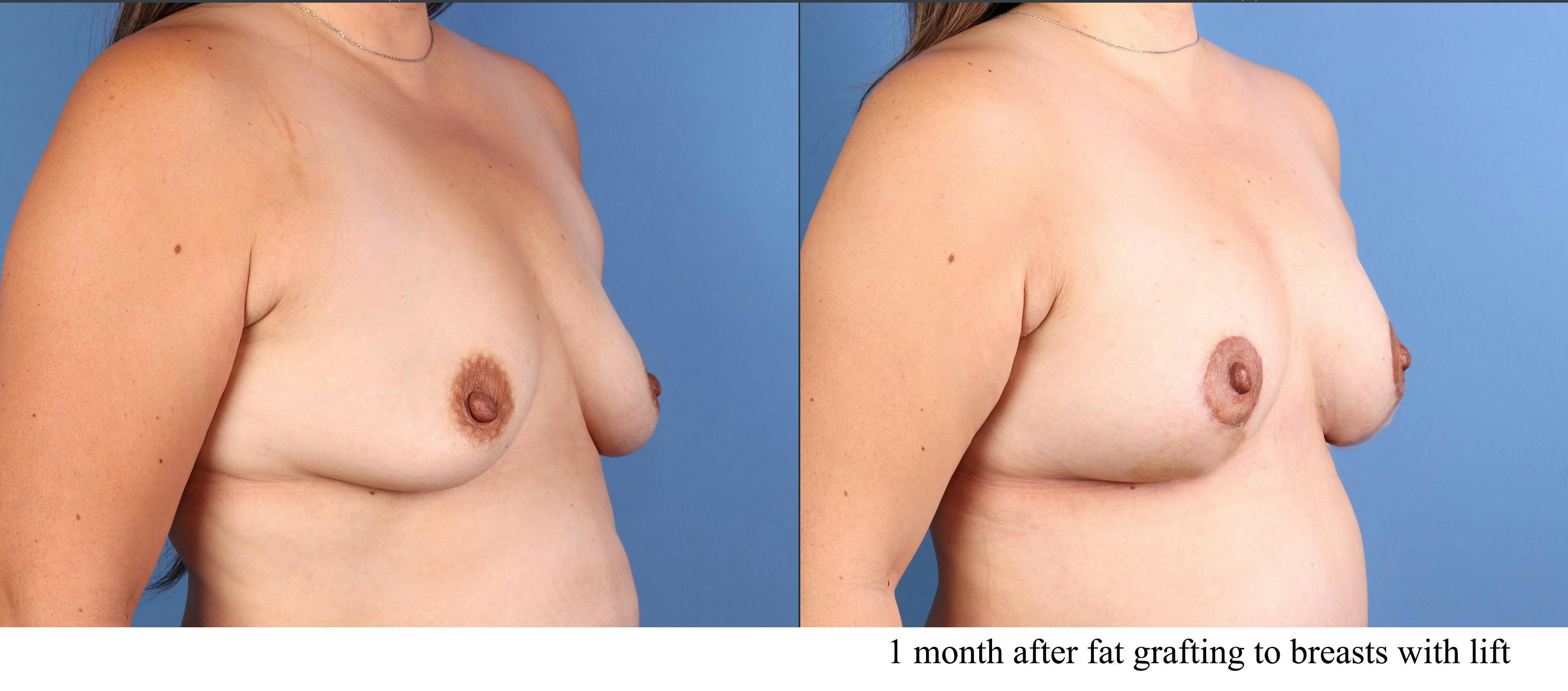 Fat Transfer Breast Augmentation Before & After Gallery - Patient 246219 - Image 1