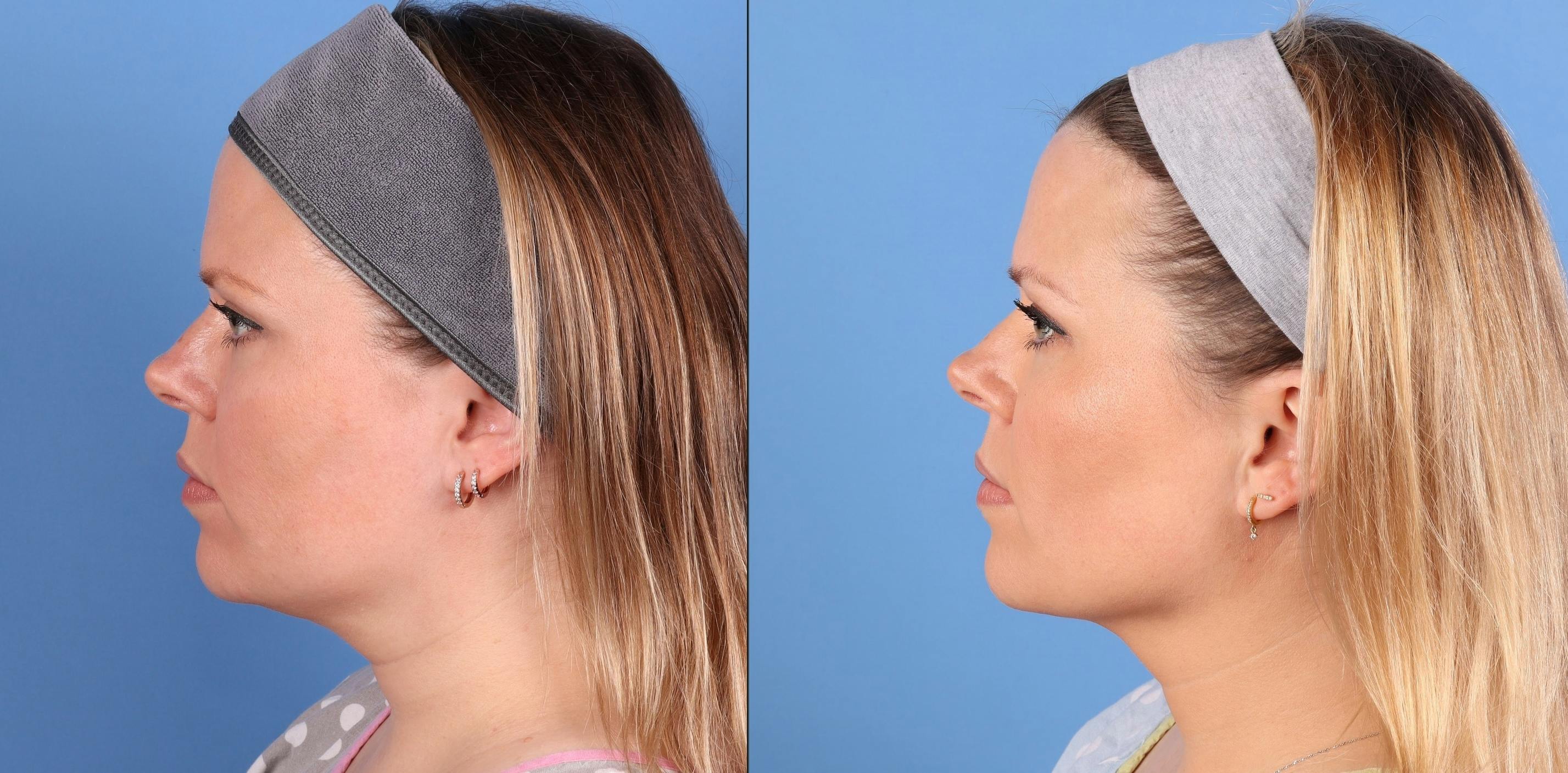 Face & Neck Before & After Gallery - Patient 562046 - Image 5