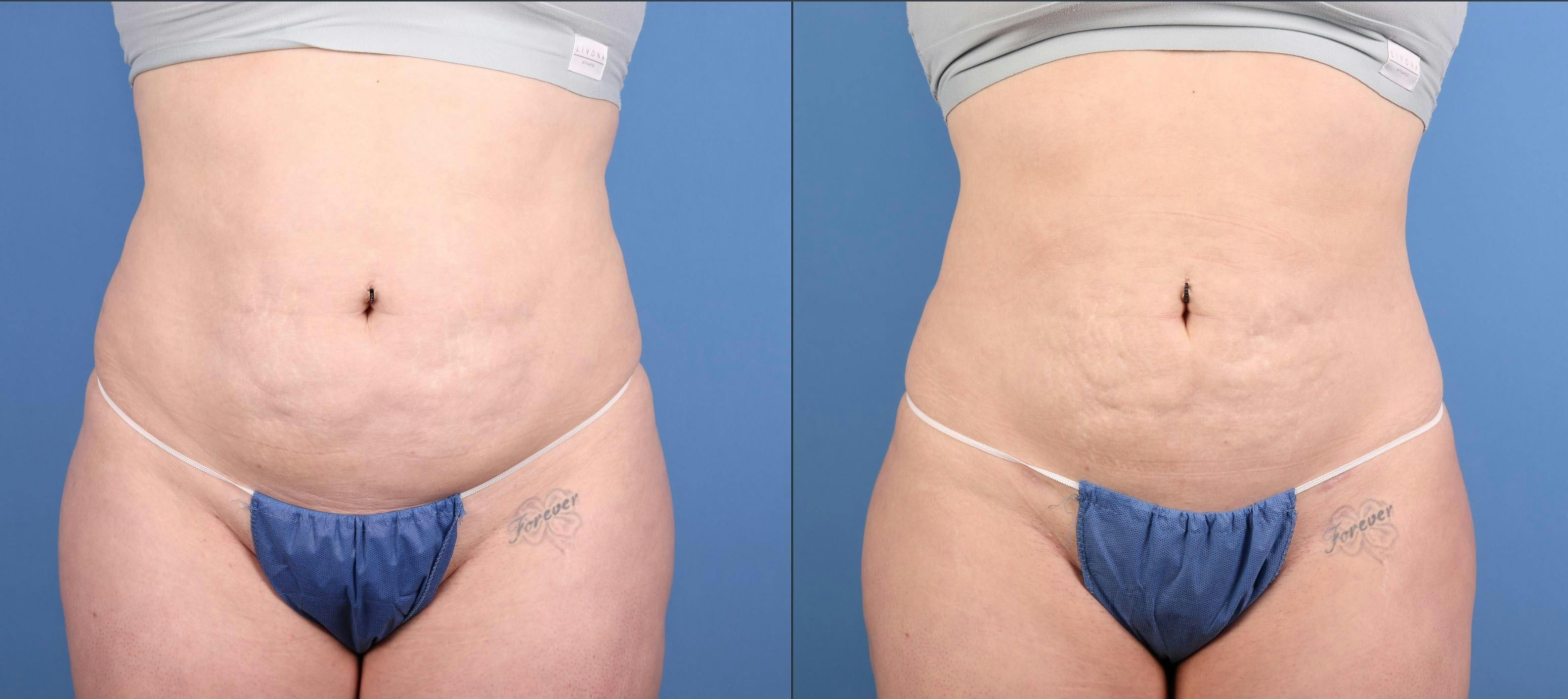 Abdomen Before & After Gallery - Patient 287538 - Image 1