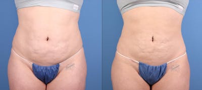 Abdomen Before & After Gallery - Patient 287538 - Image 1