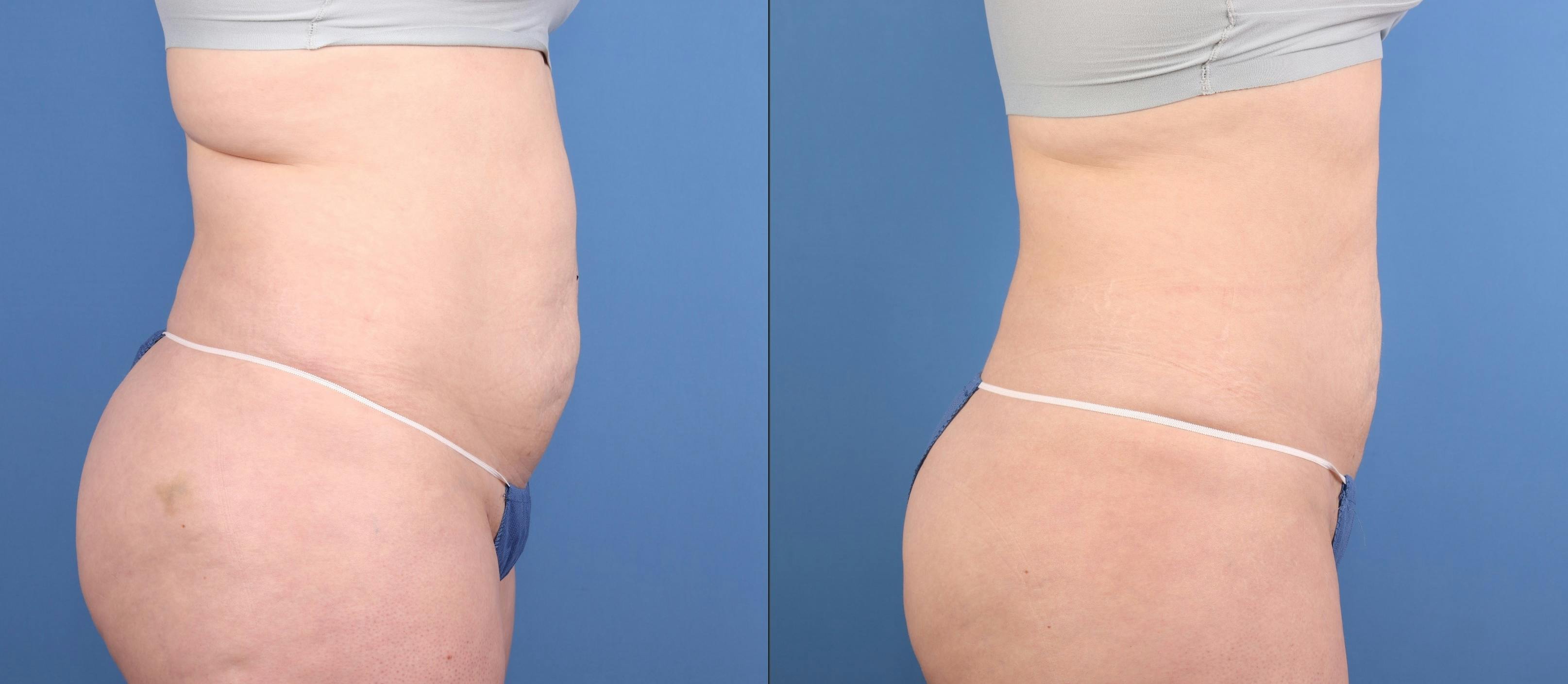 Face & Neck Before & After Gallery - Patient 562046 - Image 8