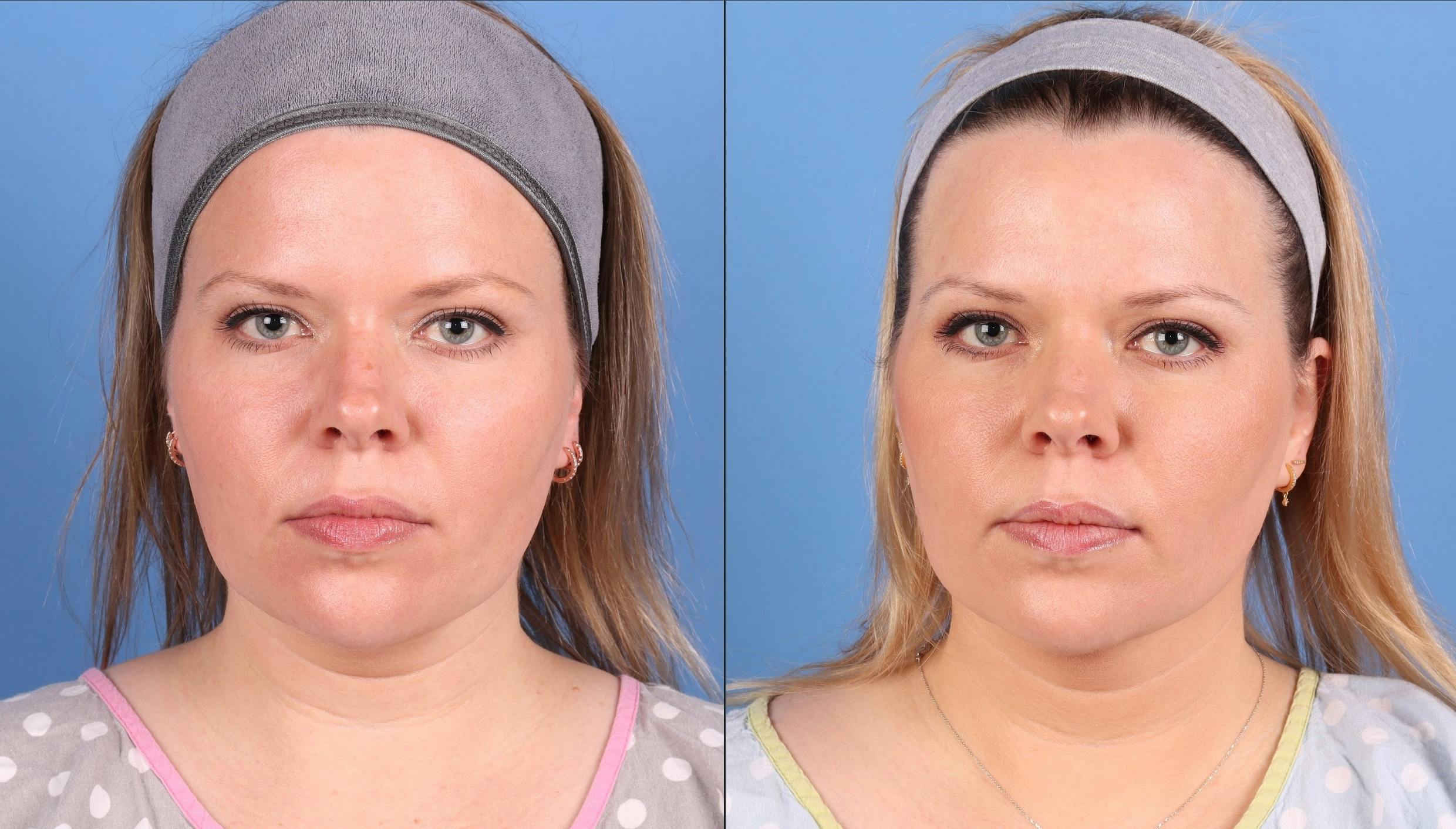 Face & Neck Before & After Gallery - Patient 562046 - Image 1