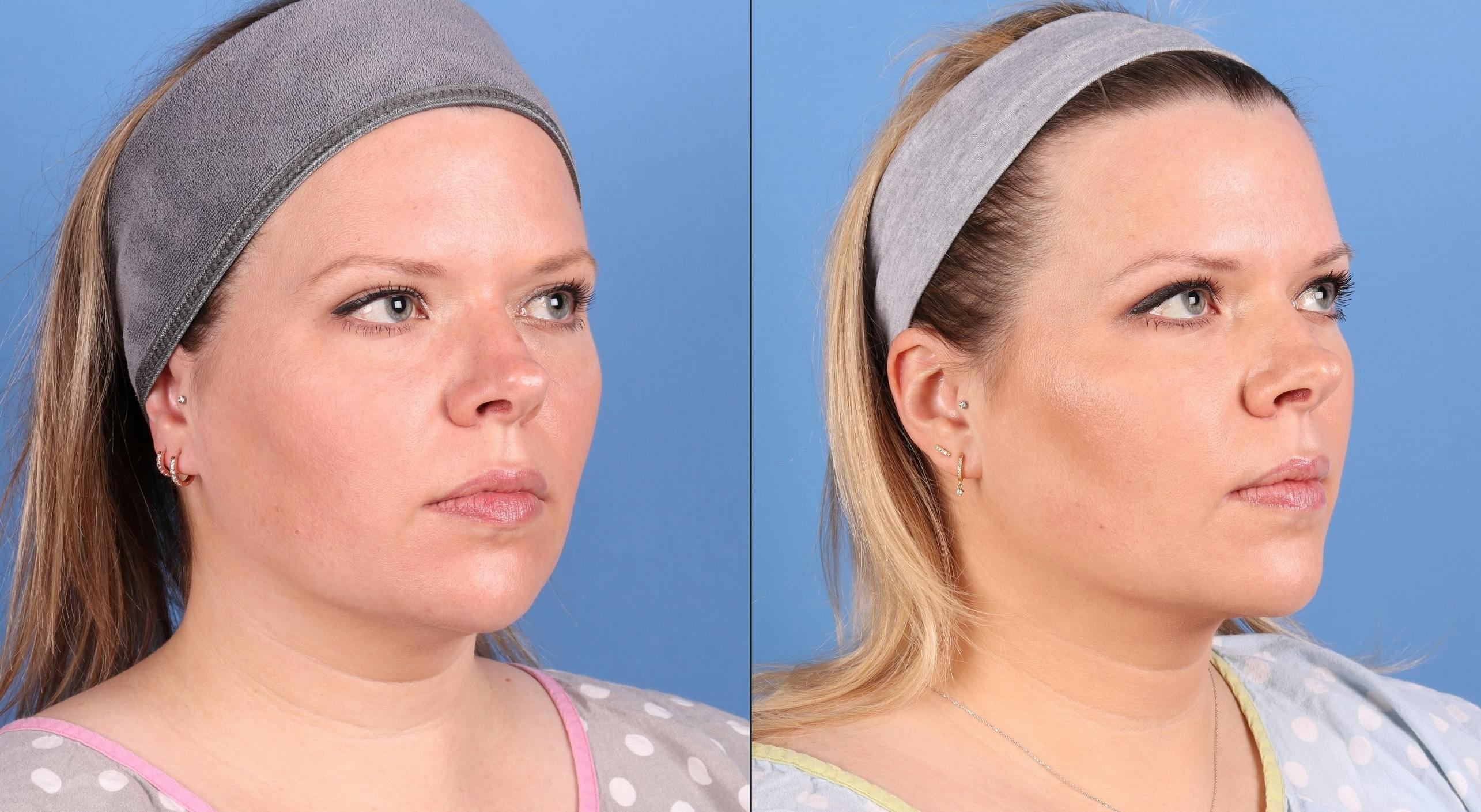 Face & Neck Before & After Gallery - Patient 562046 - Image 2