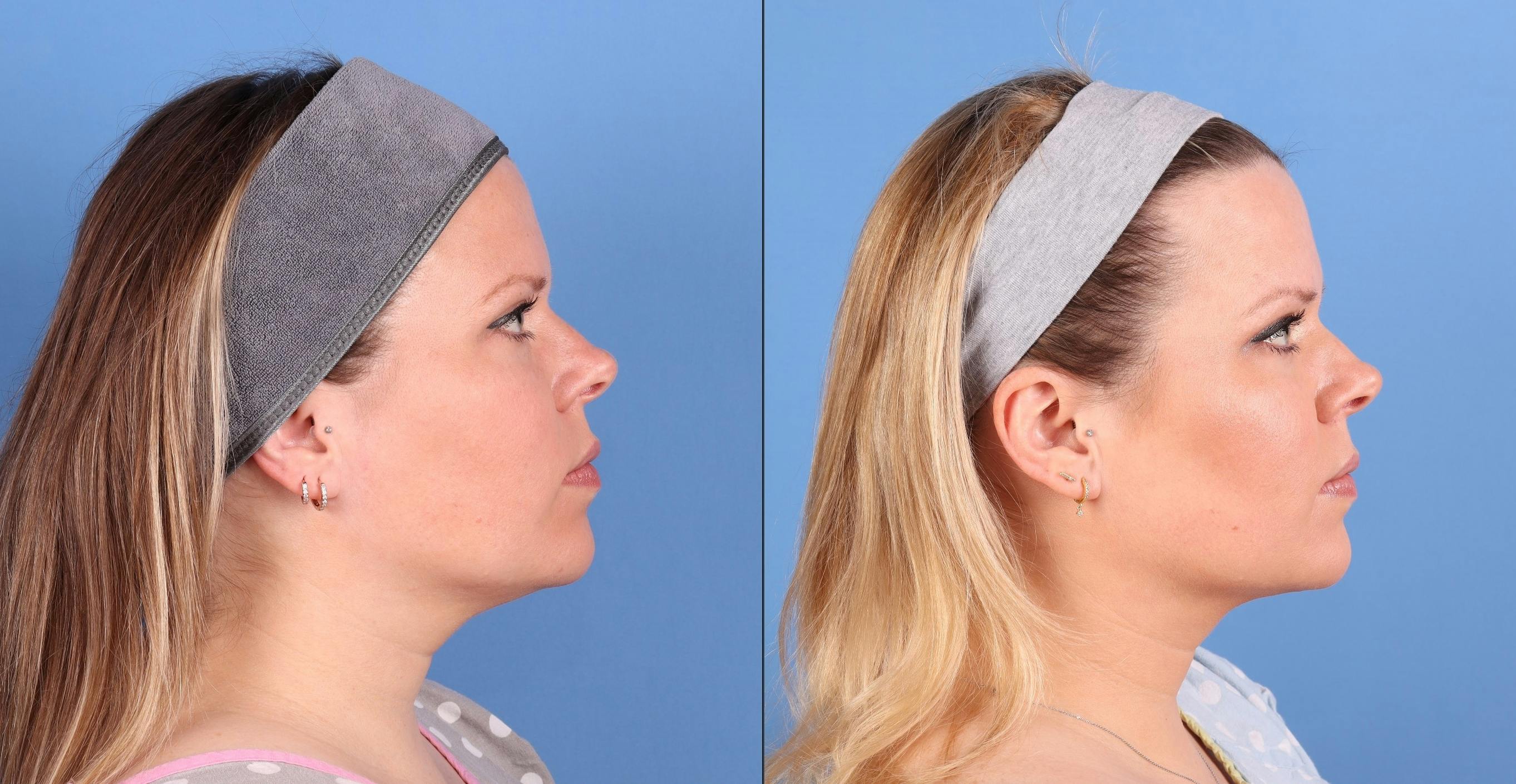 Face & Neck Before & After Gallery - Patient 562046 - Image 3