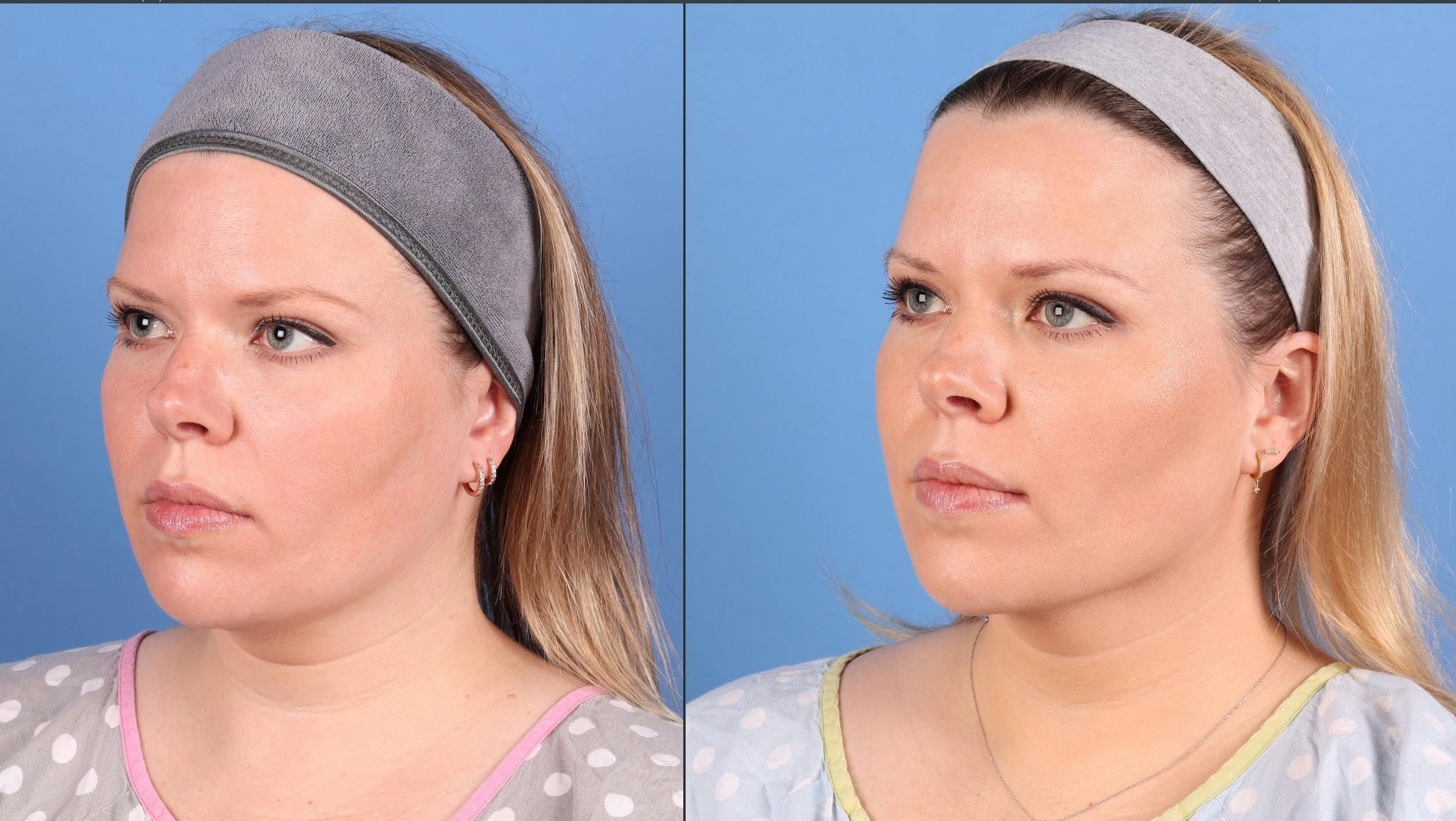 Face & Neck Before & After Gallery - Patient 562046 - Image 4
