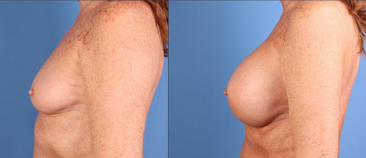 Breast Augmentation Before & After Gallery - Patient 841981 - Image 3