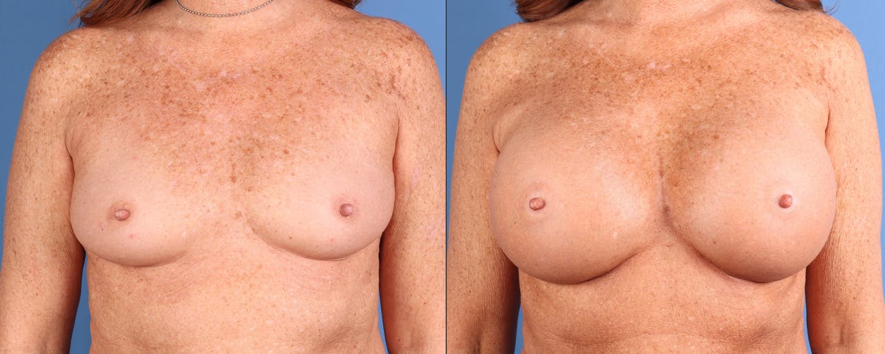 Breast Augmentation Before & After Gallery - Patient 841981 - Image 1