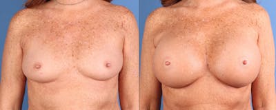 Breast Augmentation Before & After Gallery - Patient 841981 - Image 1