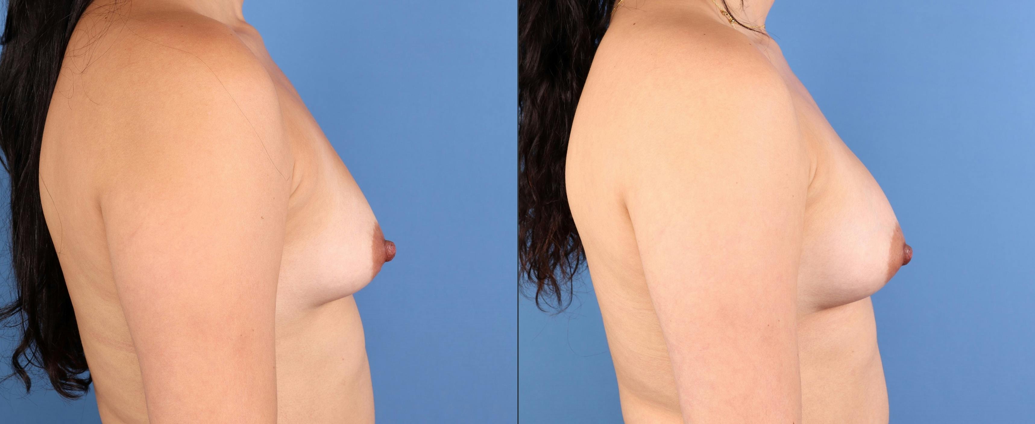 Fat Transfer Breast Augmentation Before & After Gallery - Patient 312794 - Image 3