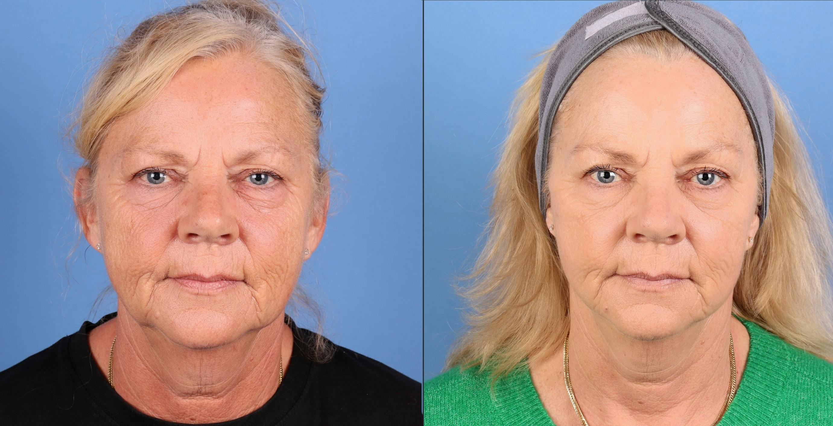 Mini Facelift Before & After Gallery - Patient 122635 - Image 1