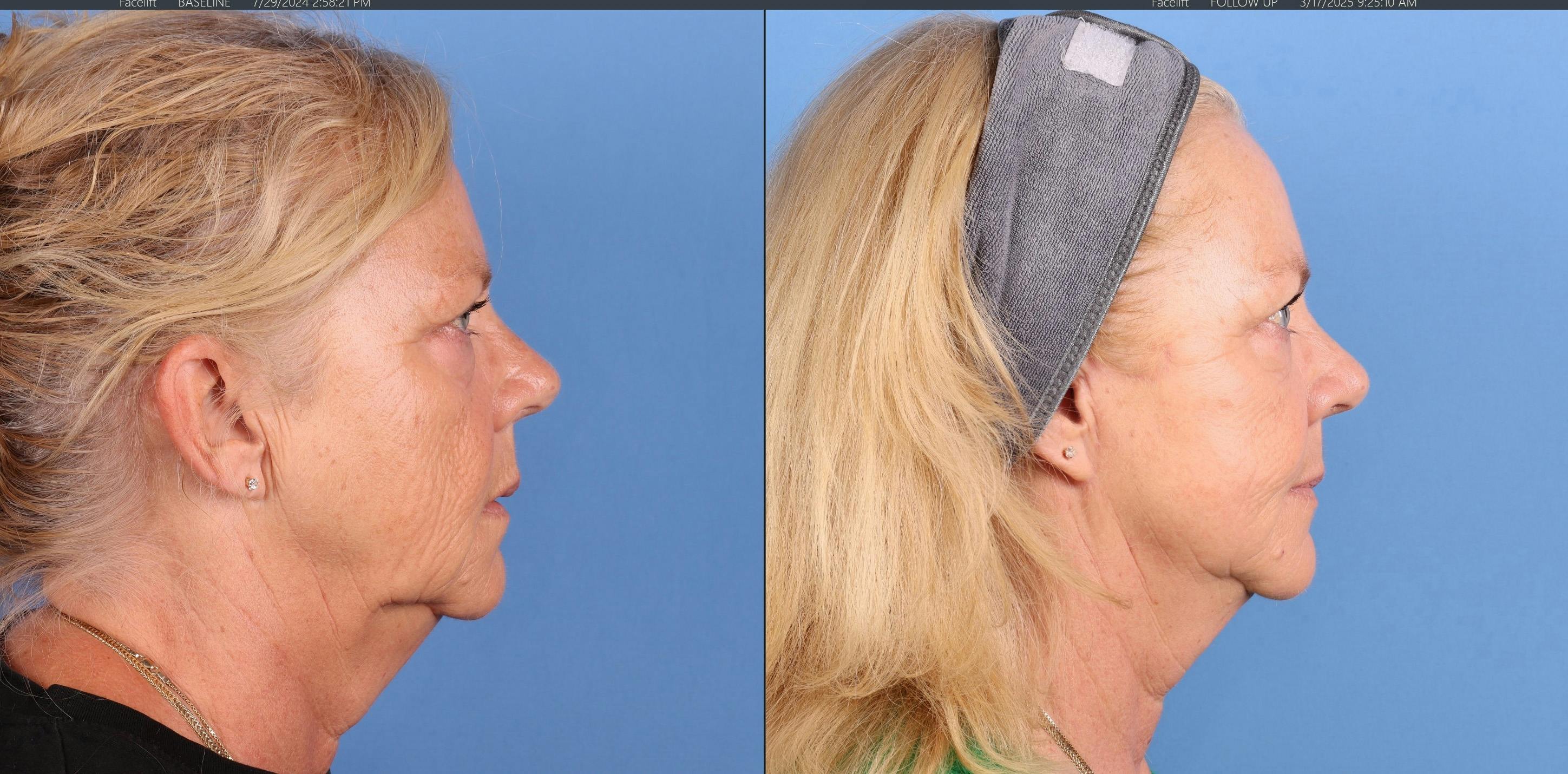 Mini Facelift Before & After Gallery - Patient 122635 - Image 3