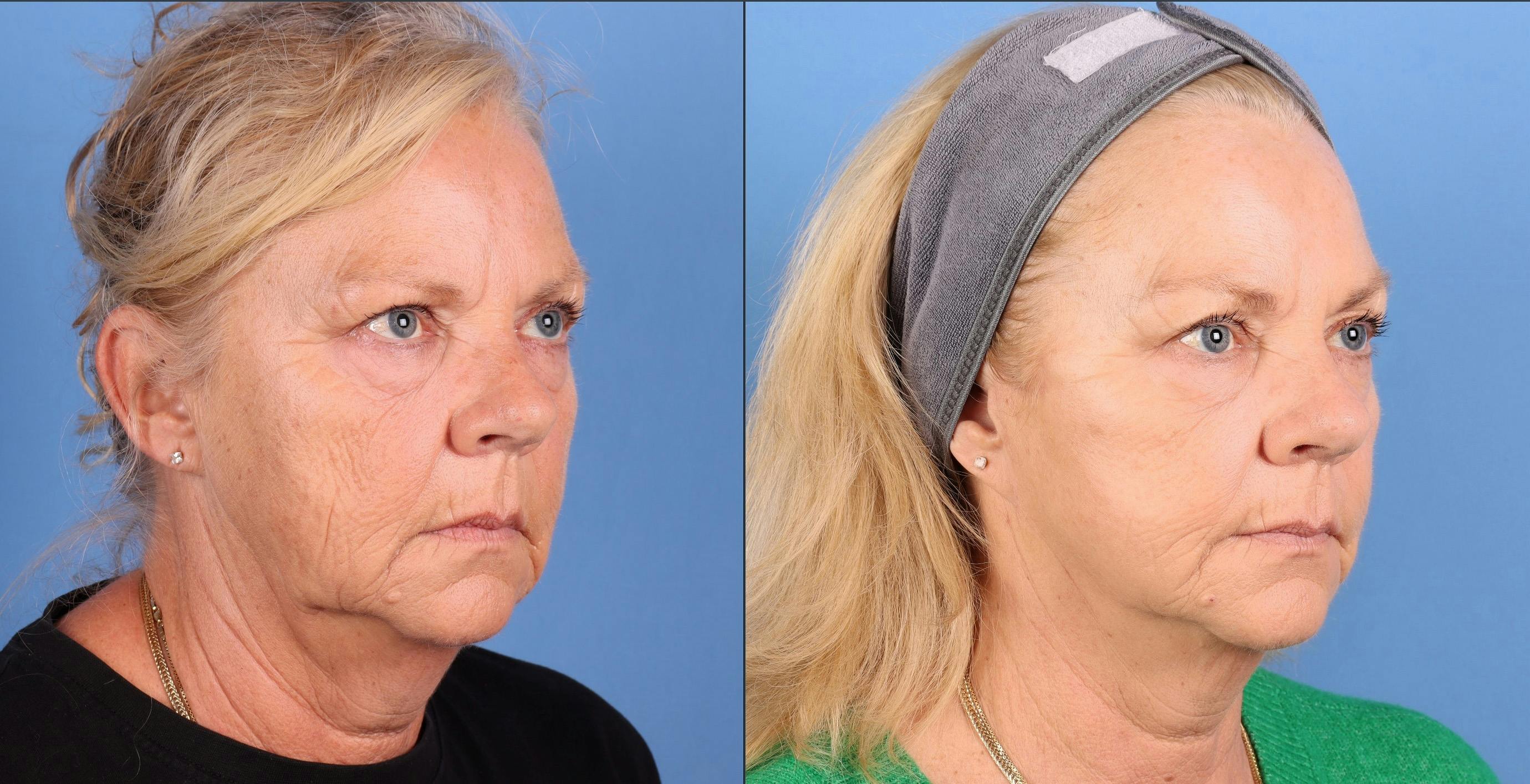 Mini Facelift Before & After Gallery - Patient 122635 - Image 2