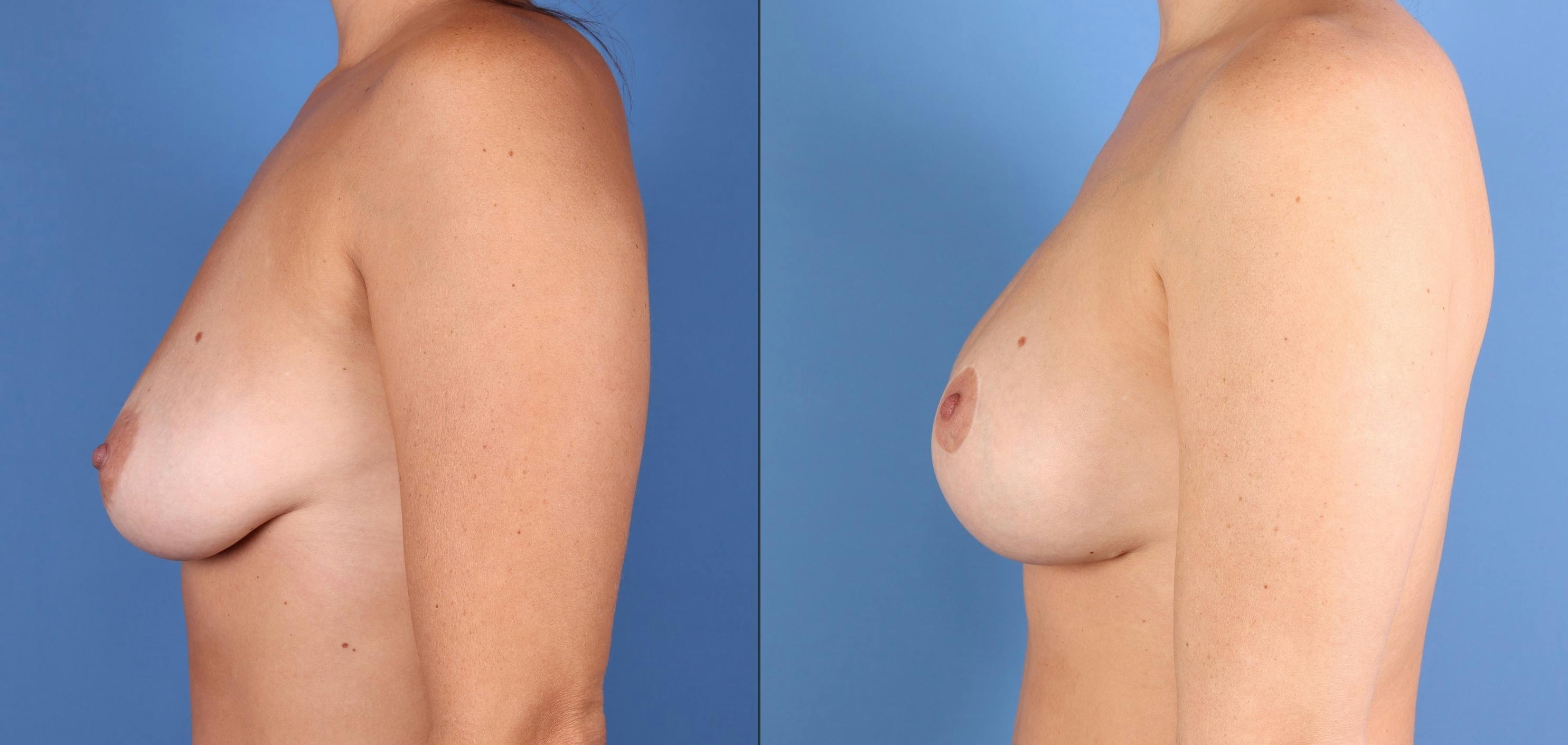 Breast Lift Before & After Gallery - Patient 311930 - Image 3