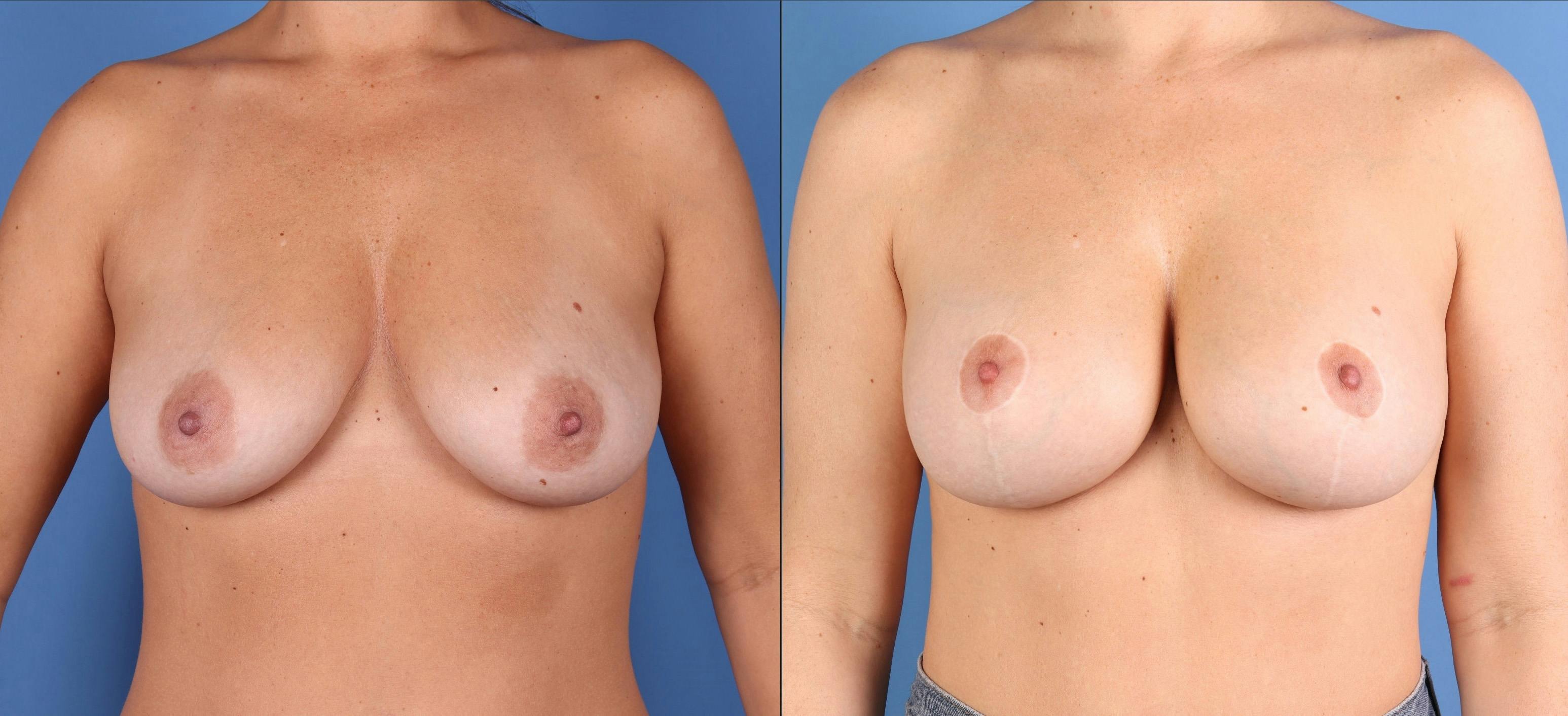 Breast Lift Before & After Gallery - Patient 311930 - Image 1