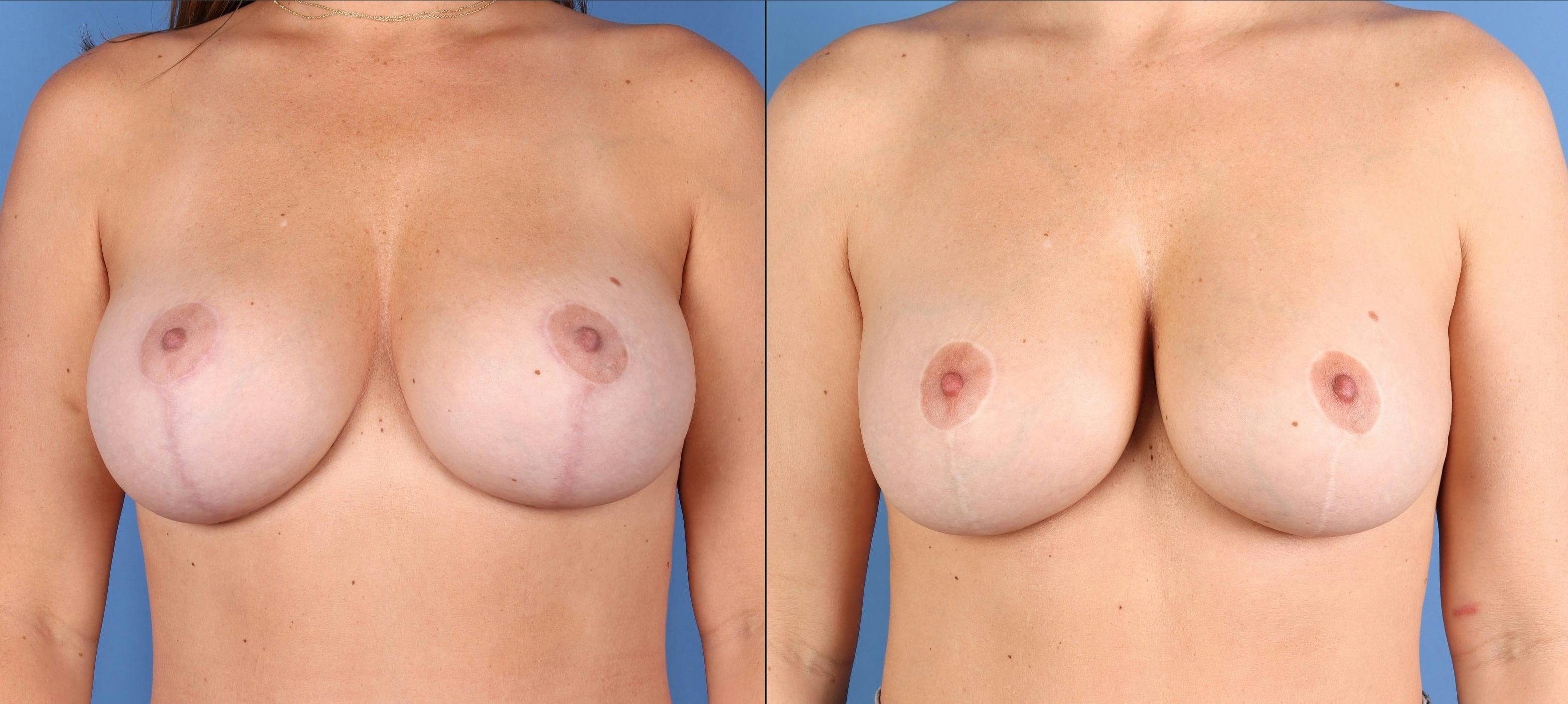 Breast Revision Before & After Gallery - Patient 254595 - Image 1