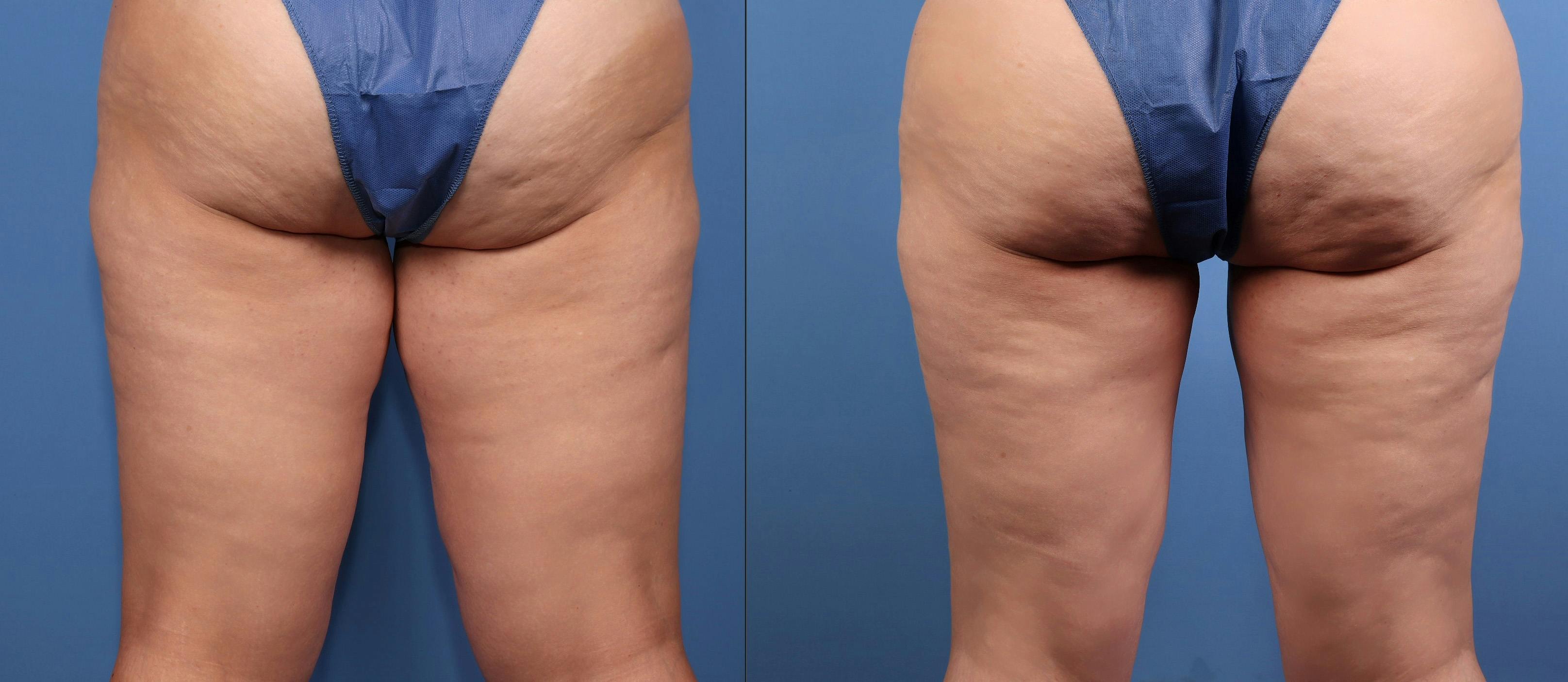 Thigh Lift Before & After Gallery - Patient 175636 - Image 4