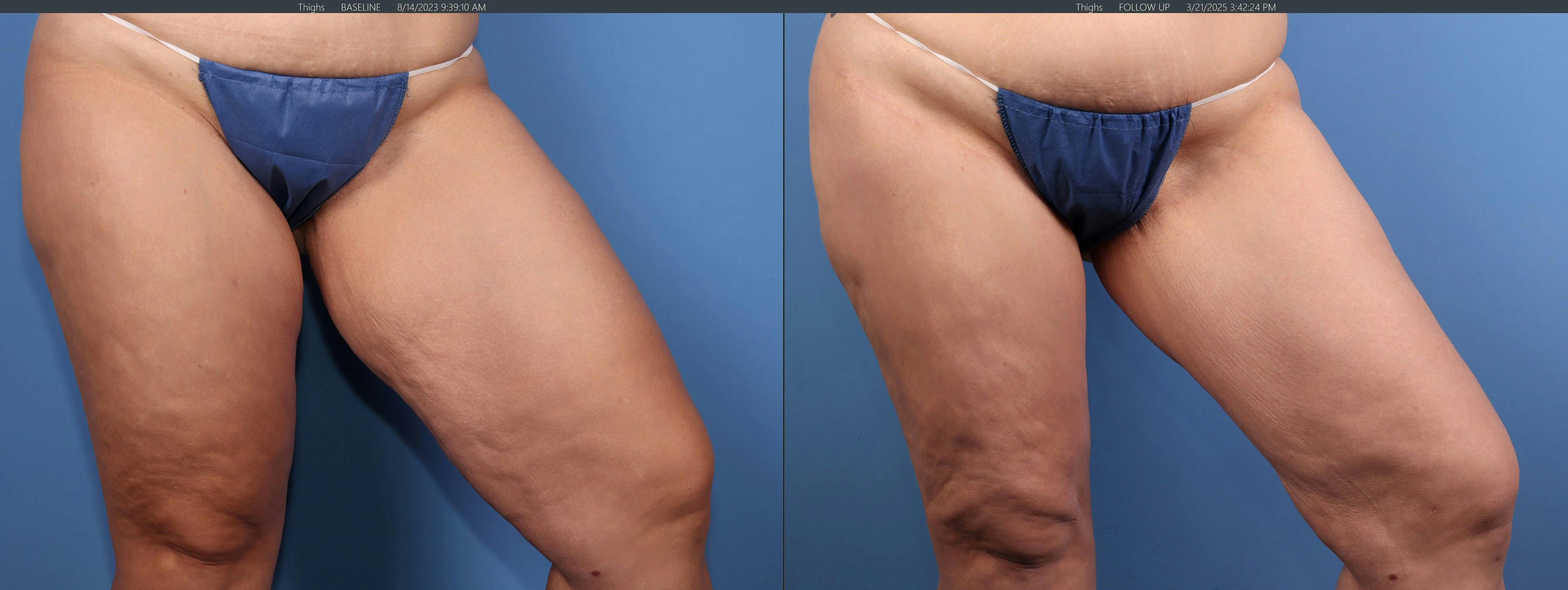 Thigh Lift Before & After Gallery - Patient 175636 - Image 3